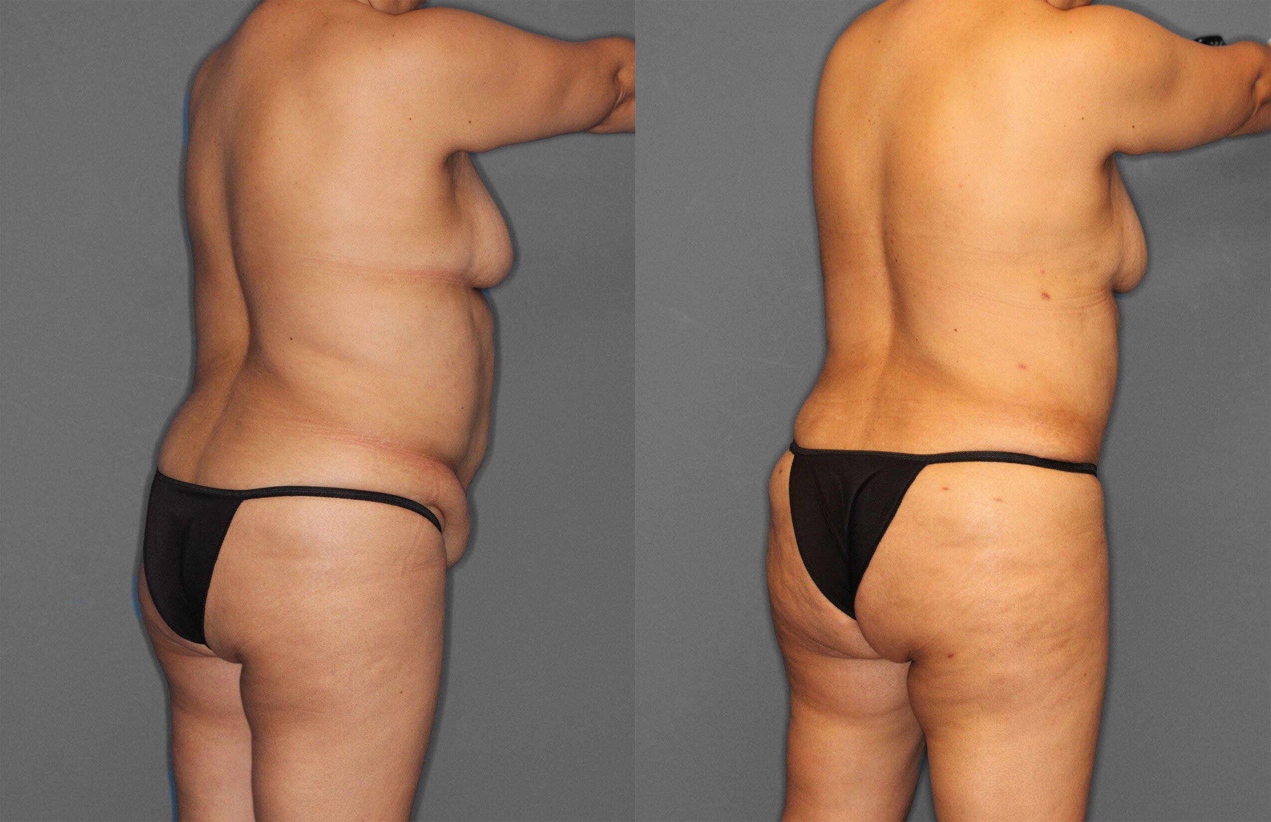 Tummy Tuck Before and After photo by Dr. Abigail Rodriguez in Houston, TX