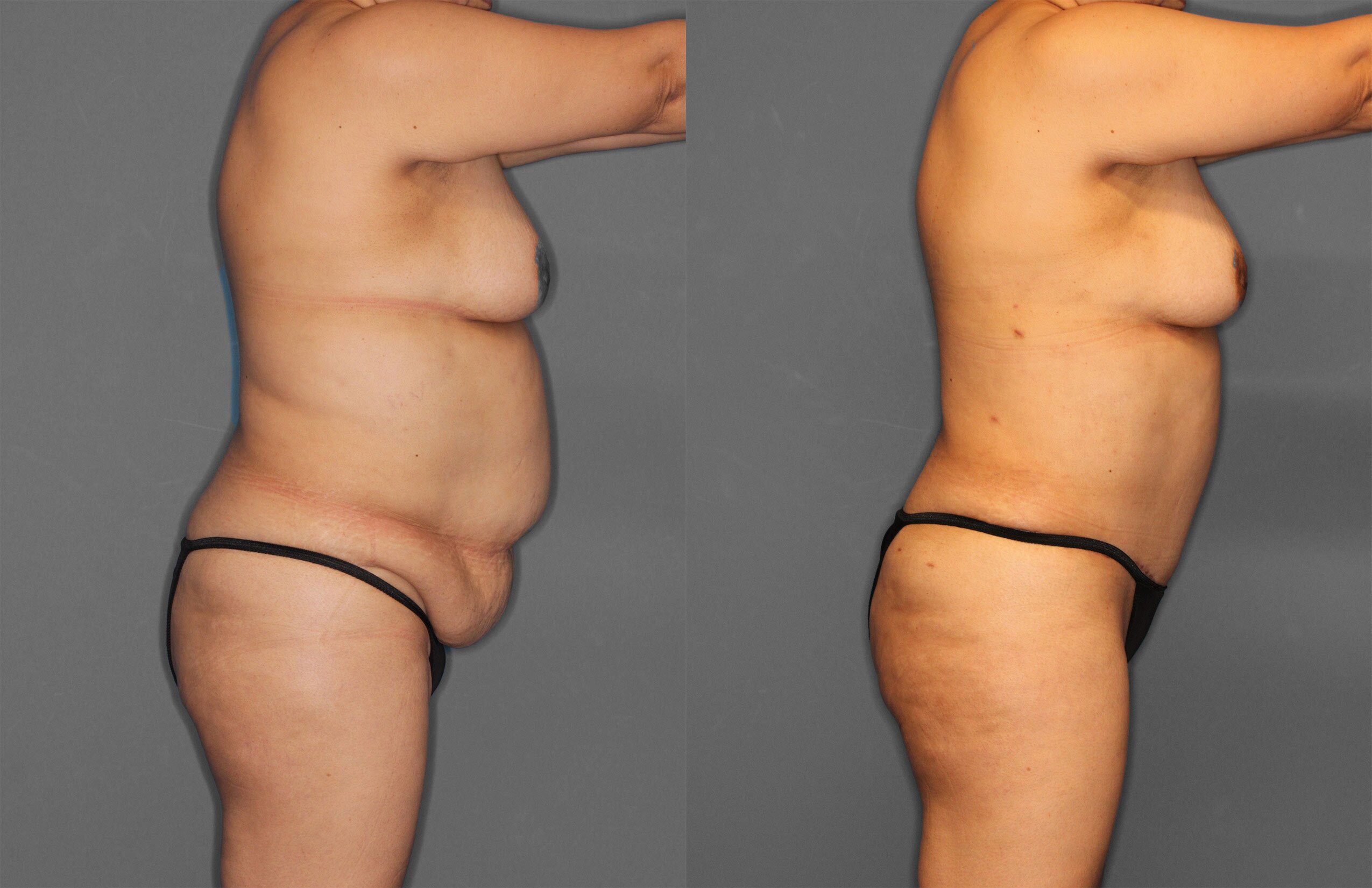 Tummy Tuck Before and After photo by Dr. Abigail Rodriguez in Houston, TX
