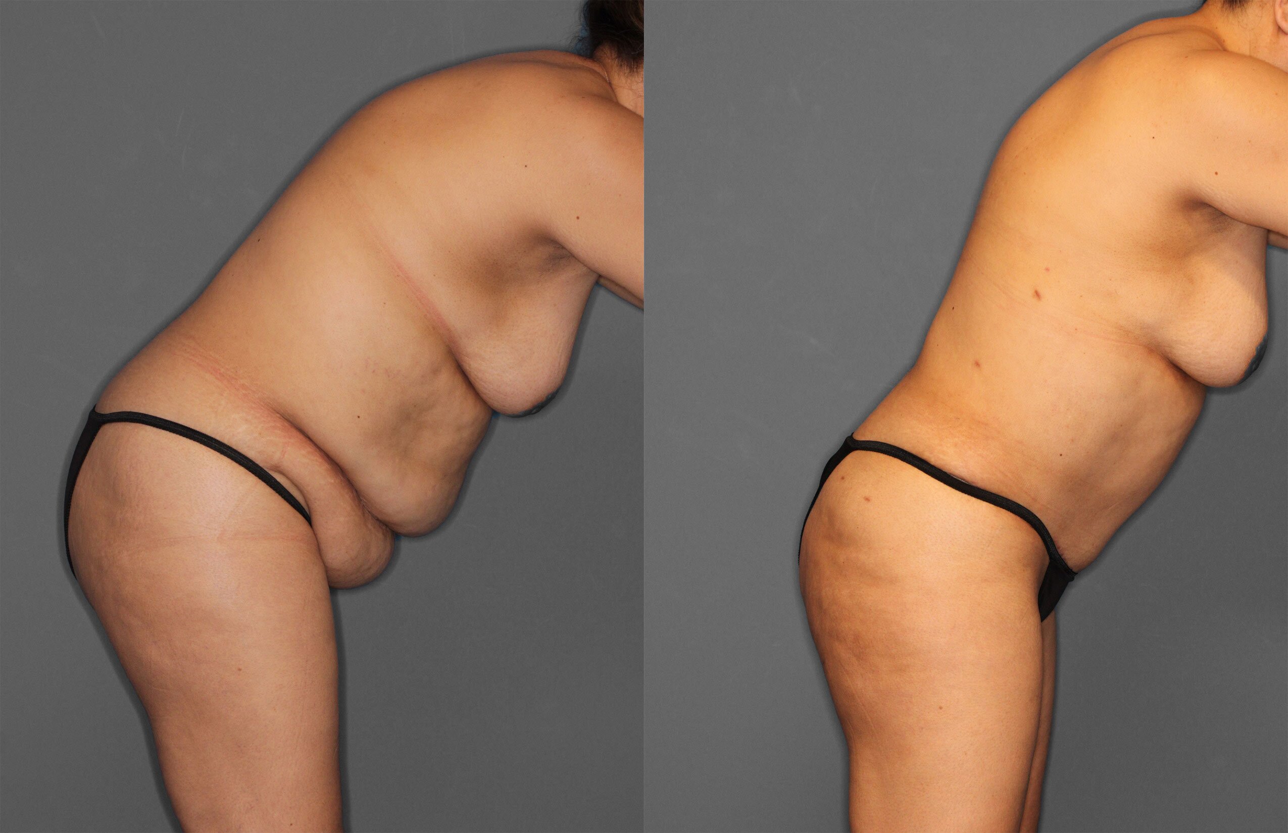 Tummy Tuck Before and After photo by Dr. Abigail Rodriguez in Houston, TX