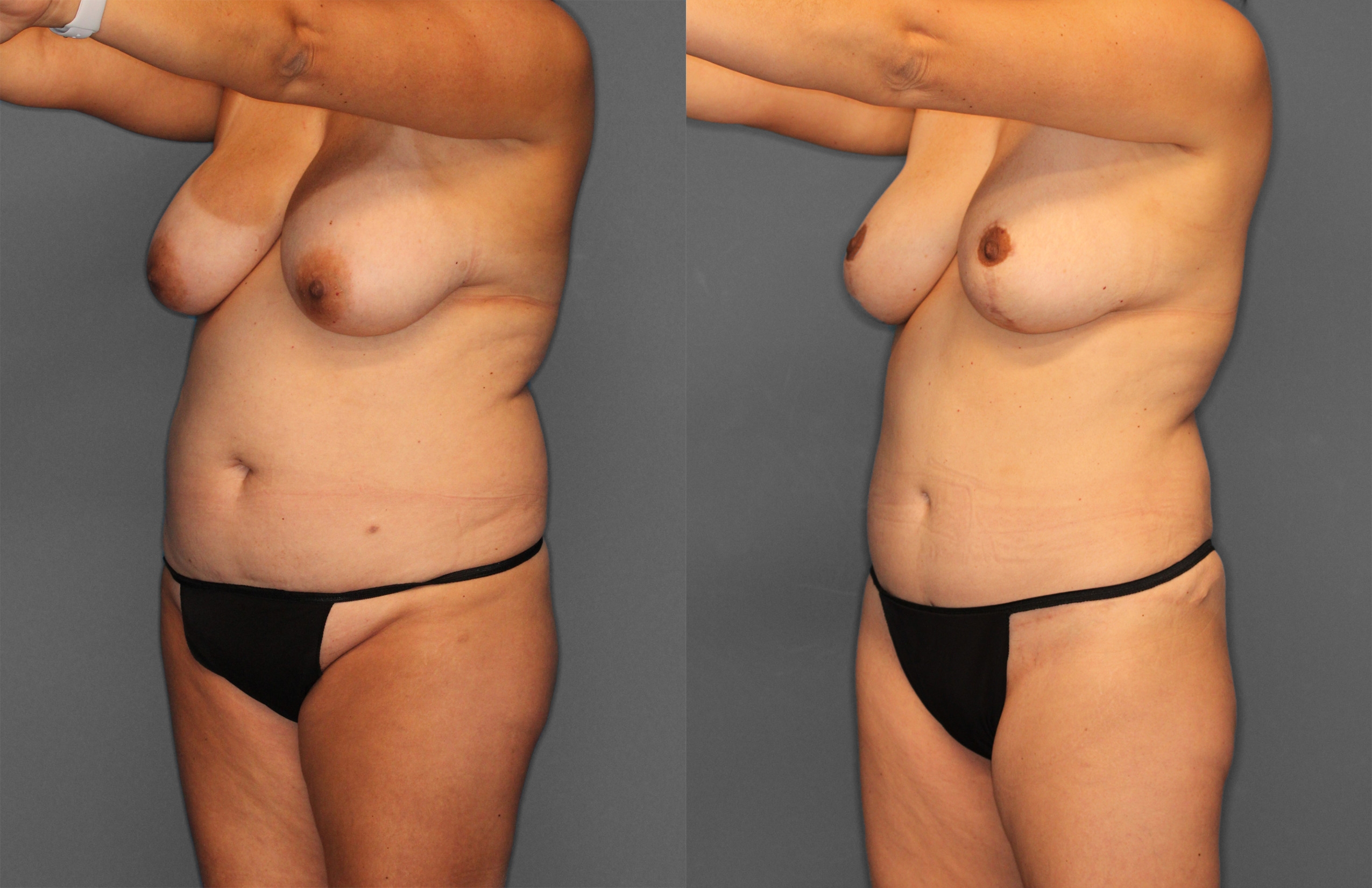 Tummy Tuck Before and After photo by Dr. Abigail Rodriguez in Houston, TX