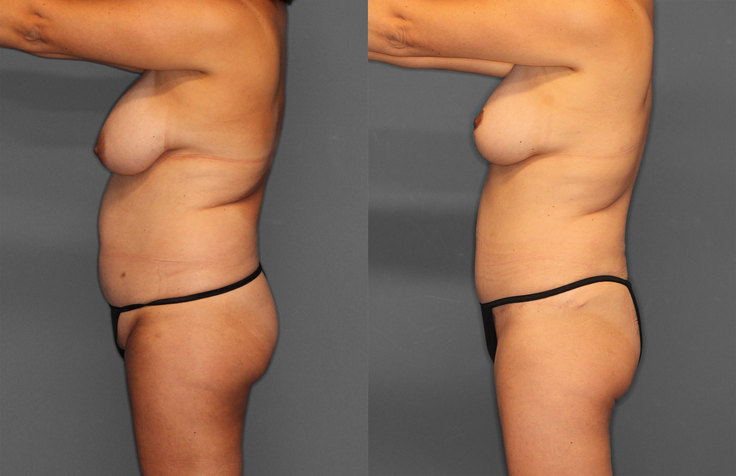 Tummy Tuck Before and After photo by Dr. Abigail Rodriguez in Houston, TX