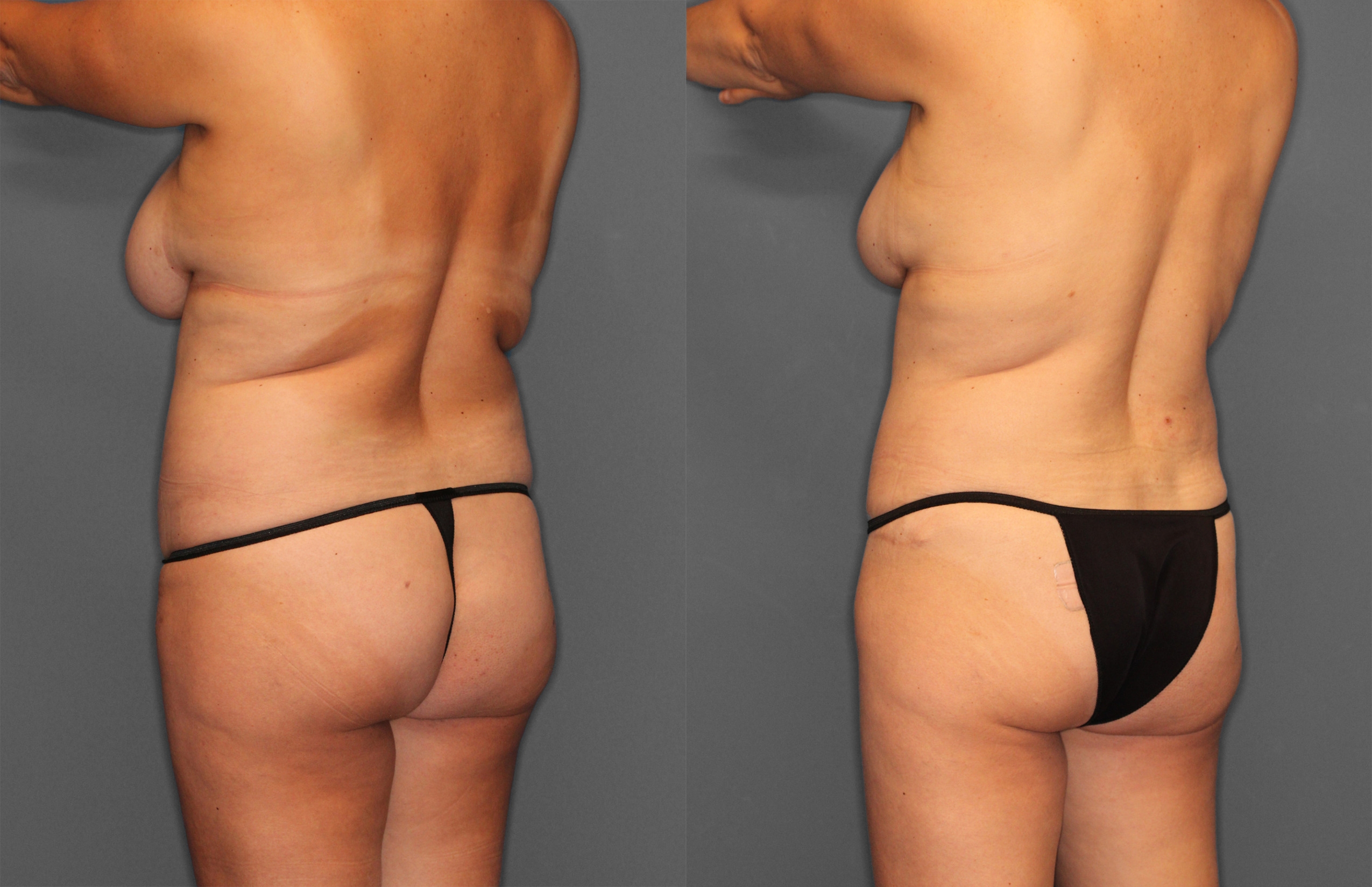 Tummy Tuck Before and After photo by Dr. Abigail Rodriguez in Houston, TX