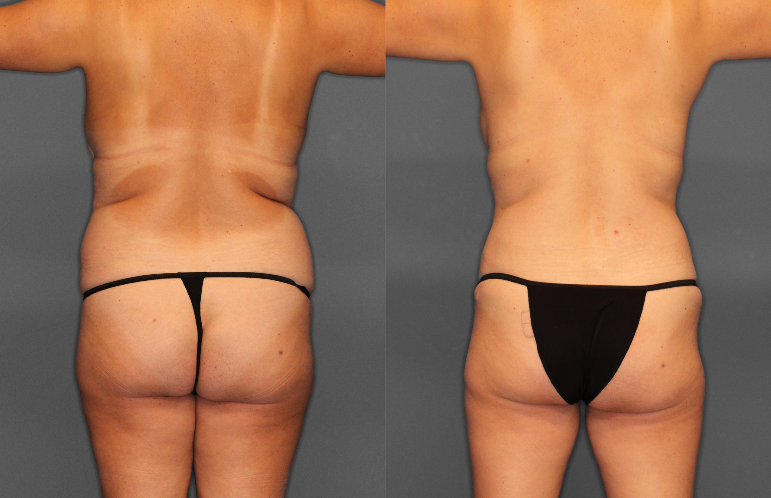Tummy Tuck Before and After photo by Dr. Abigail Rodriguez in Houston, TX