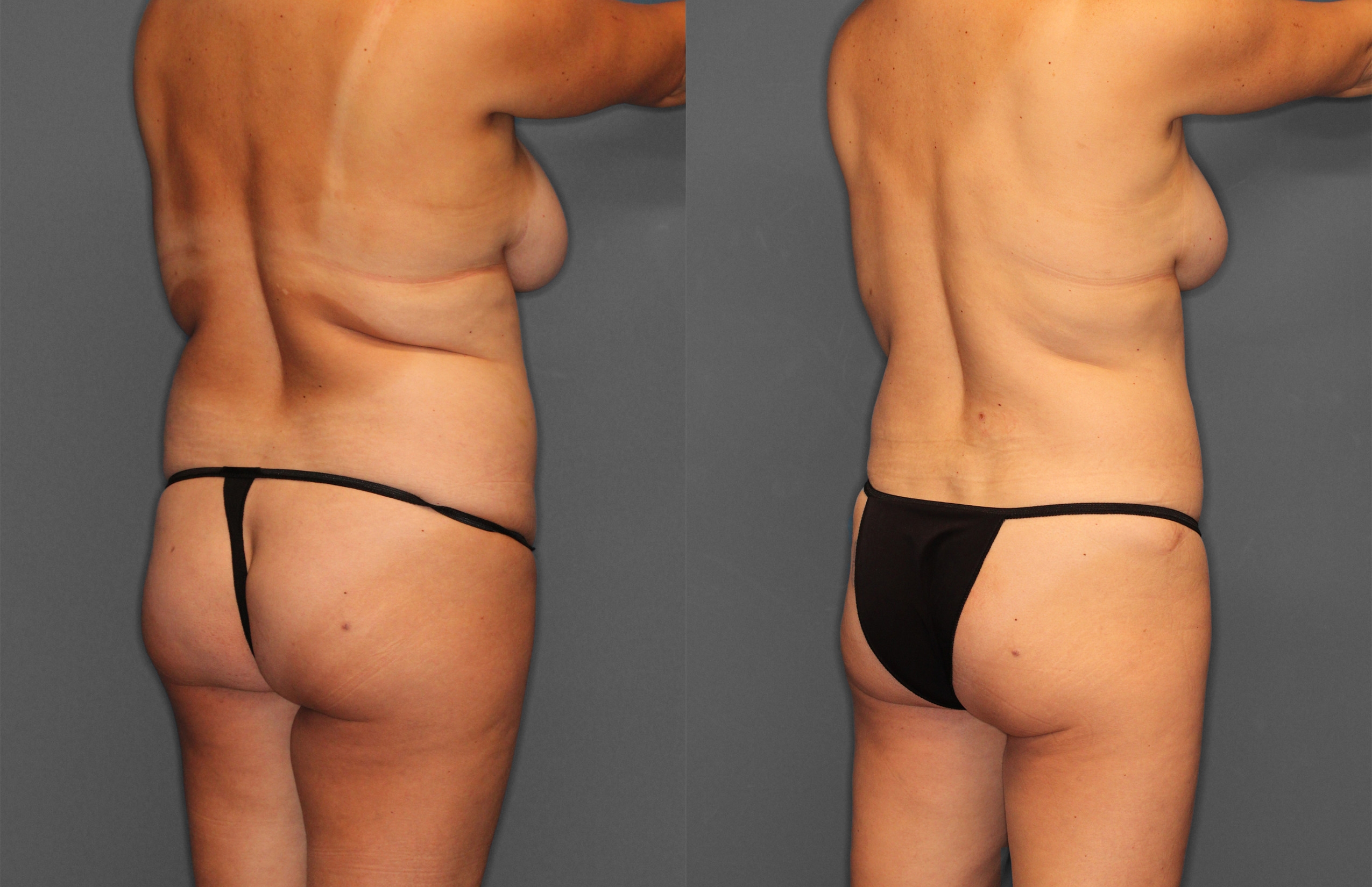 Tummy Tuck Before and After photo by Dr. Abigail Rodriguez in Houston, TX