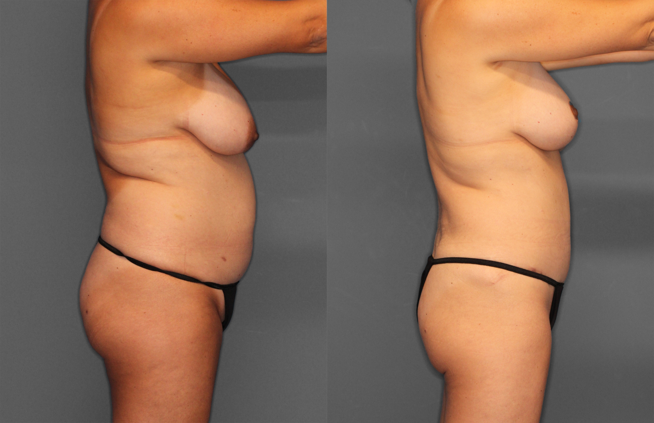 Tummy Tuck Before and After photo by Dr. Abigail Rodriguez in Houston, TX