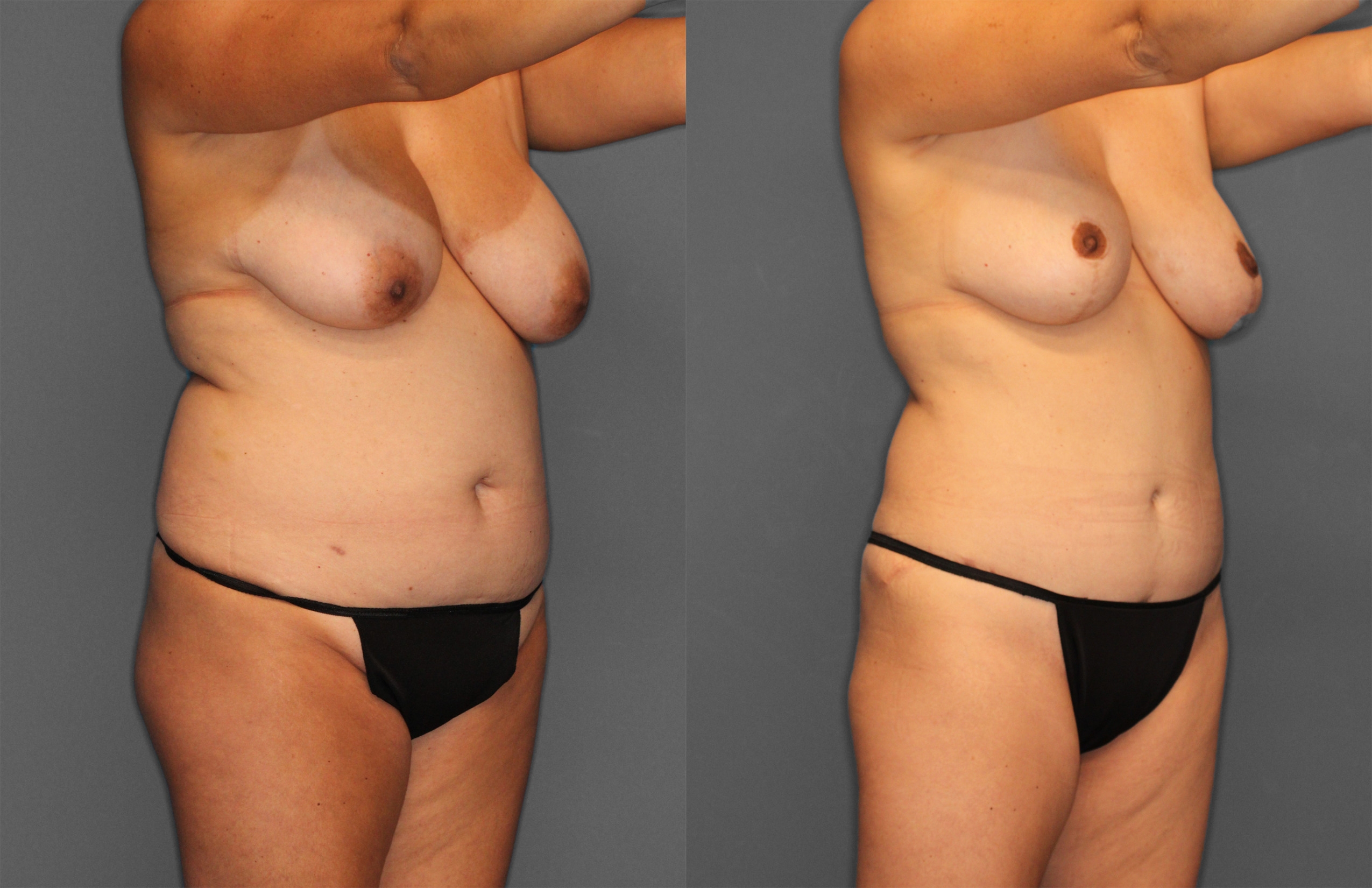 Tummy Tuck Before and After photo by Dr. Abigail Rodriguez in Houston, TX