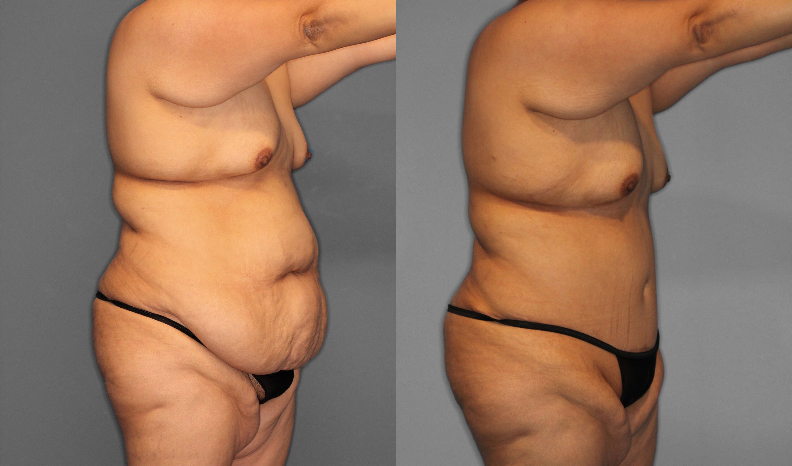 Tummy Tuck Before and After photo by Dr. Abigail Rodriguez in Houston, TX