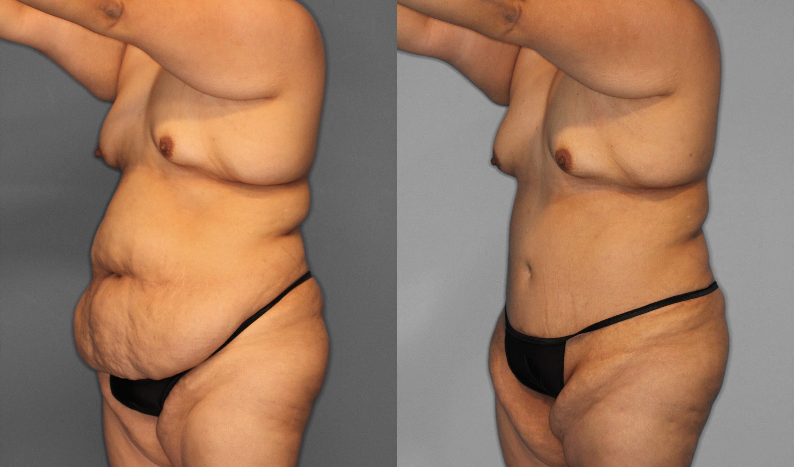 Tummy Tuck Before and After photo by Dr. Abigail Rodriguez in Houston, TX