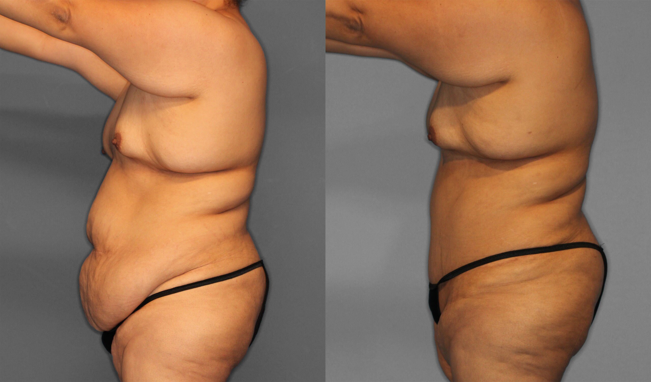 Tummy Tuck Before and After photo by Dr. Abigail Rodriguez in Houston, TX
