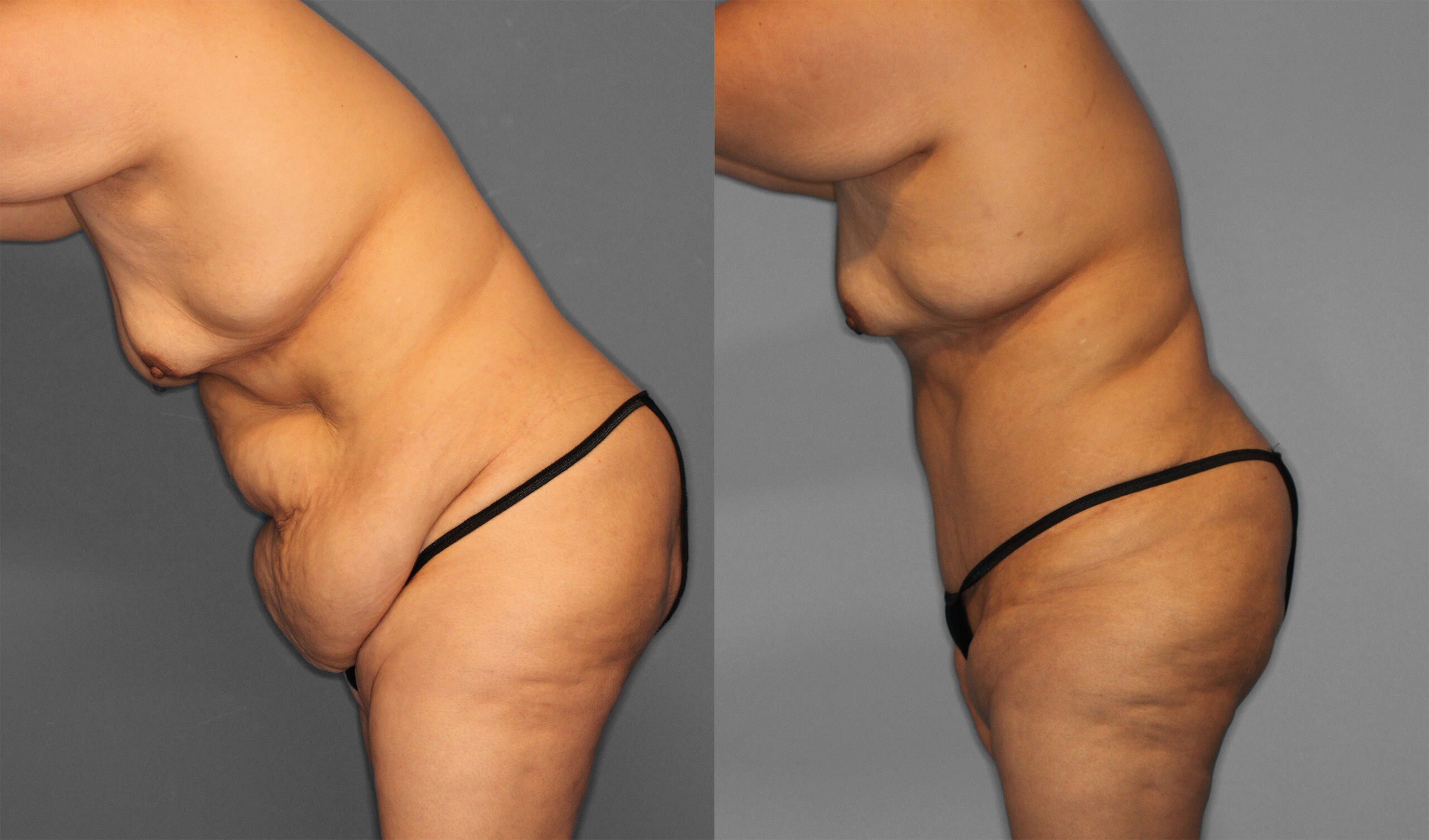 Tummy Tuck Before and After photo by Dr. Abigail Rodriguez in Houston, TX