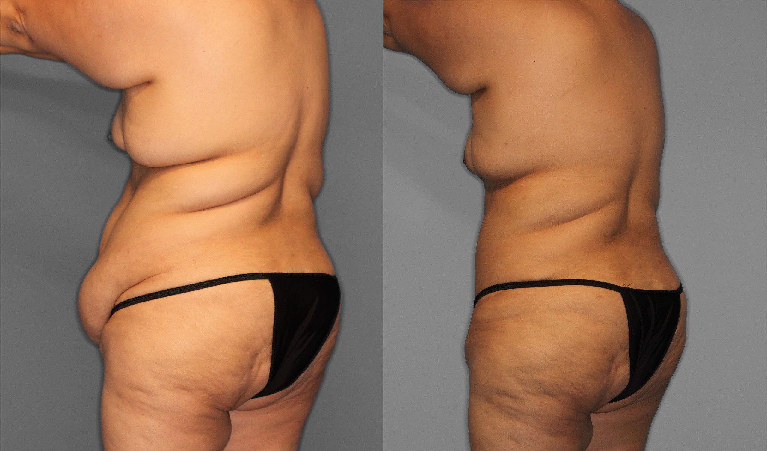 Tummy Tuck Before and After photo by Dr. Abigail Rodriguez in Houston, TX
