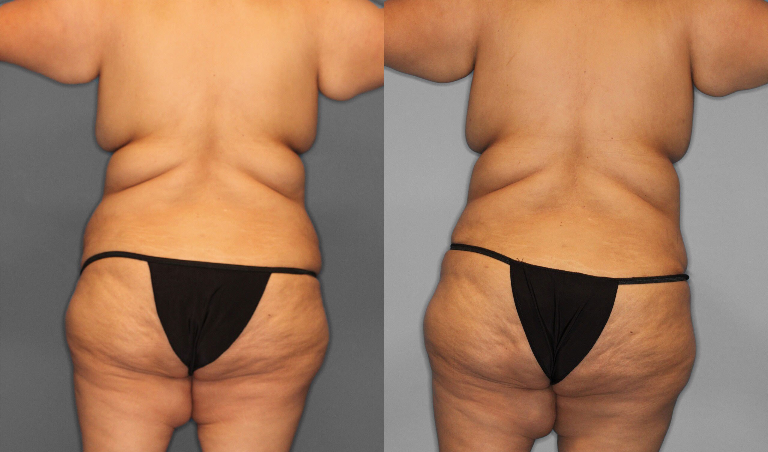 Tummy Tuck Before and After photo by Dr. Abigail Rodriguez in Houston, TX
