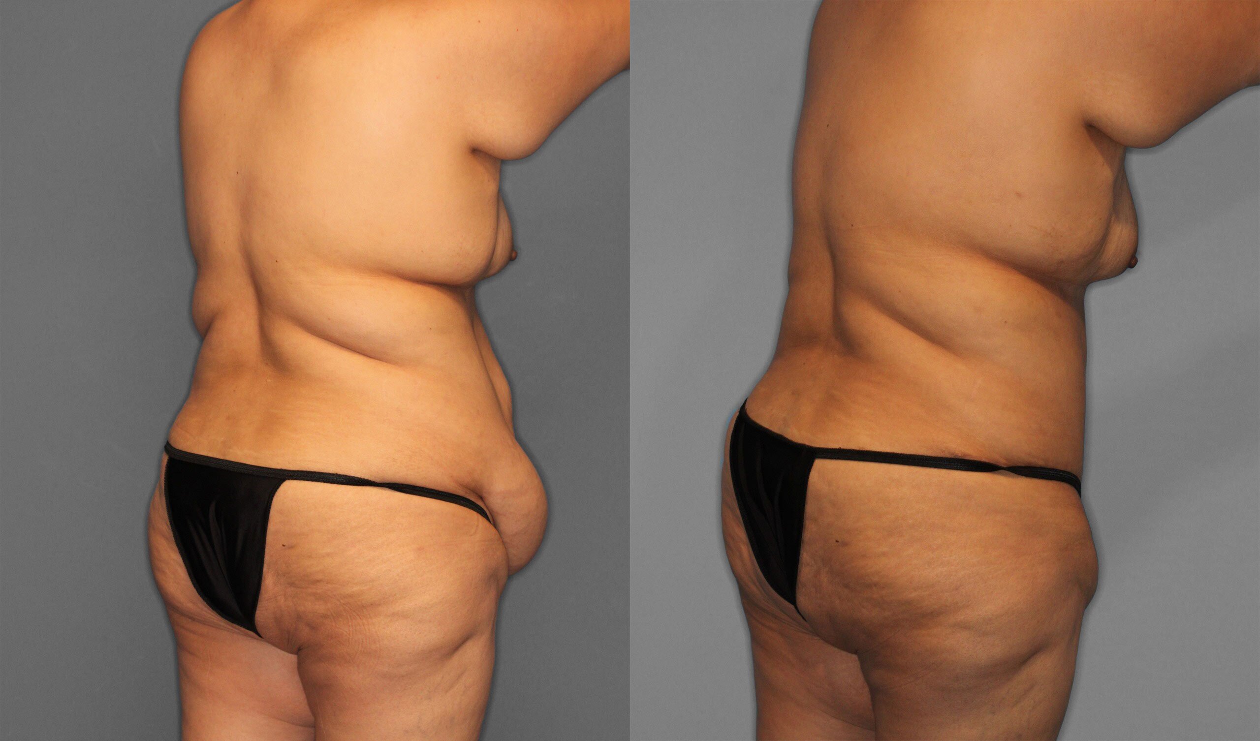 Tummy Tuck Before and After photo by Dr. Abigail Rodriguez in Houston, TX