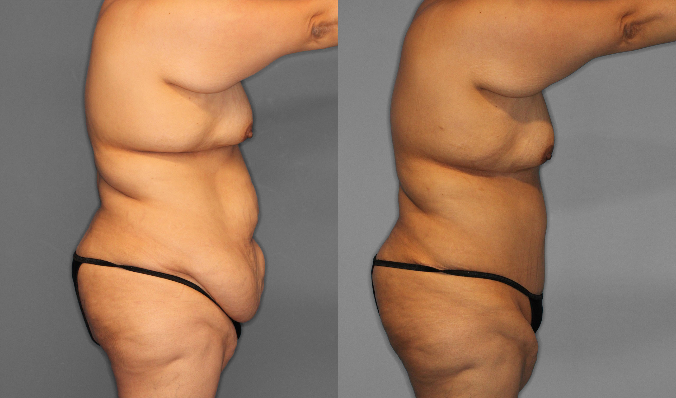 Tummy Tuck Before and After photo by Dr. Abigail Rodriguez in Houston, TX