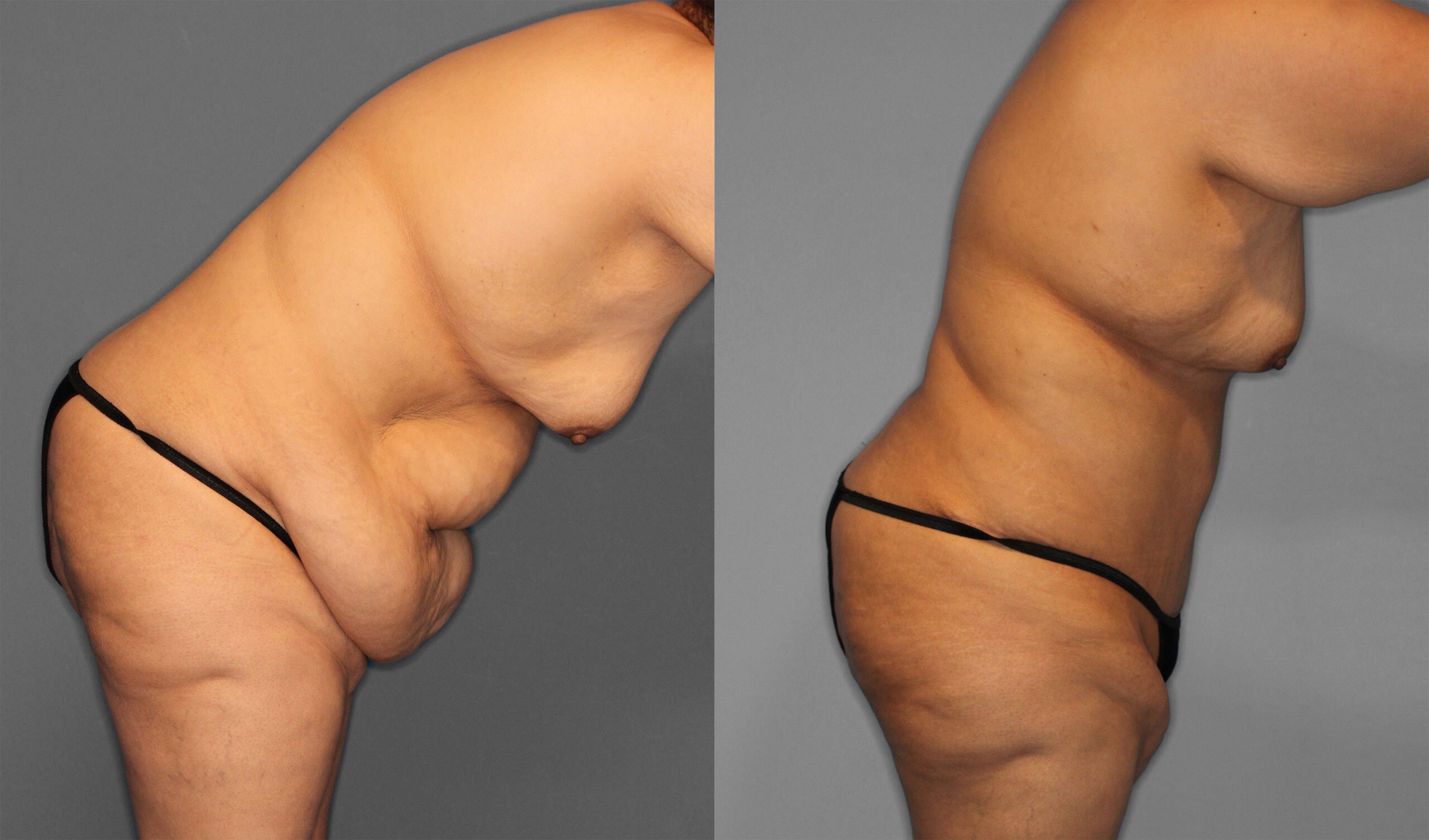 Tummy Tuck Before and After photo by Dr. Abigail Rodriguez in Houston, TX