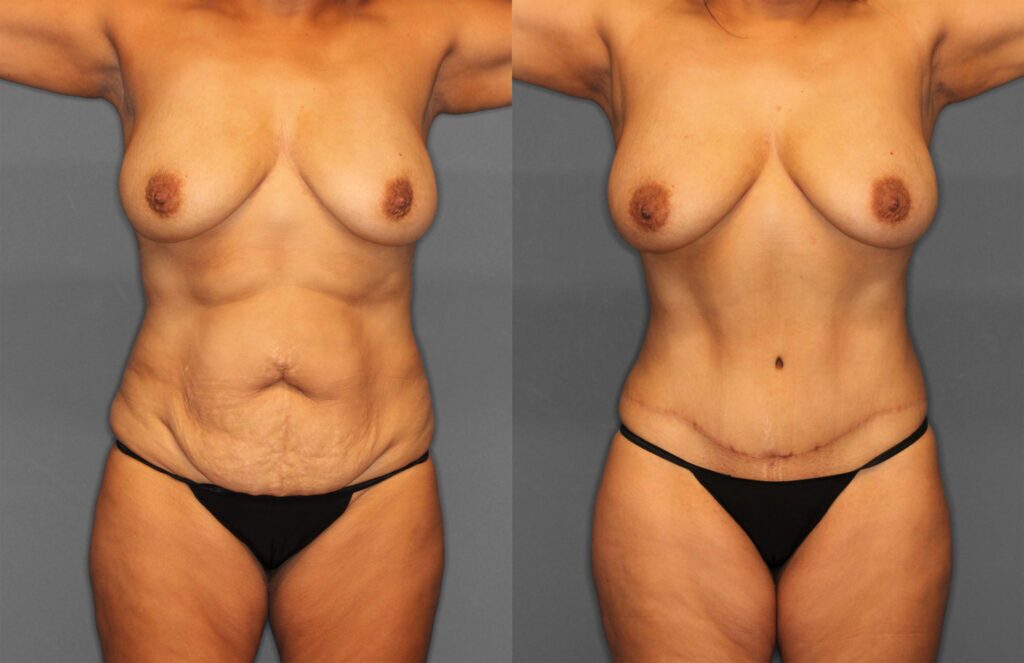 Tummy Tuck Before and After photo by Dr. Abigail Rodriguez in Houston, TX
