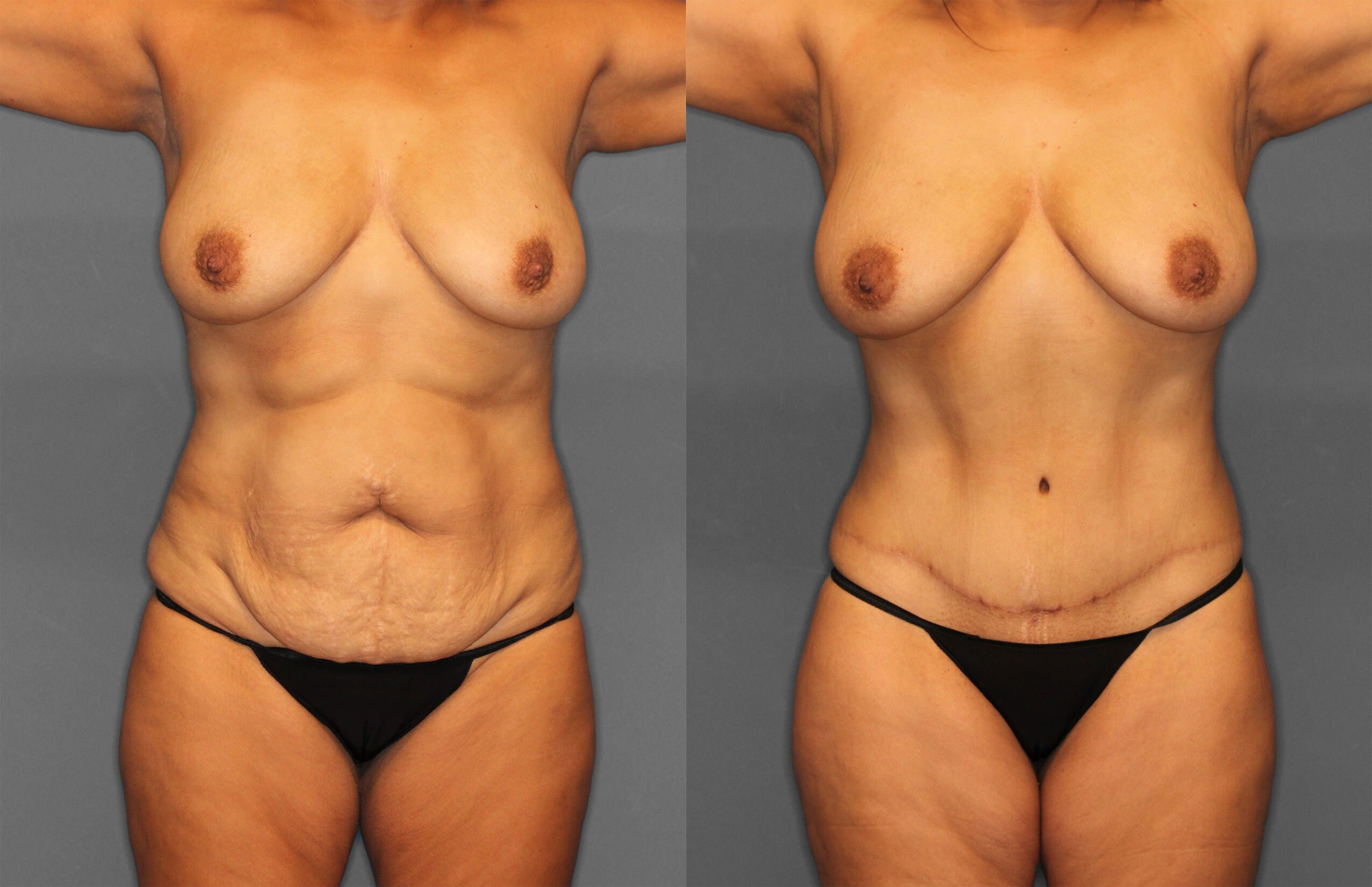 Tummy Tuck Before and After photo by Dr. Abigail Rodriguez in Houston, TX