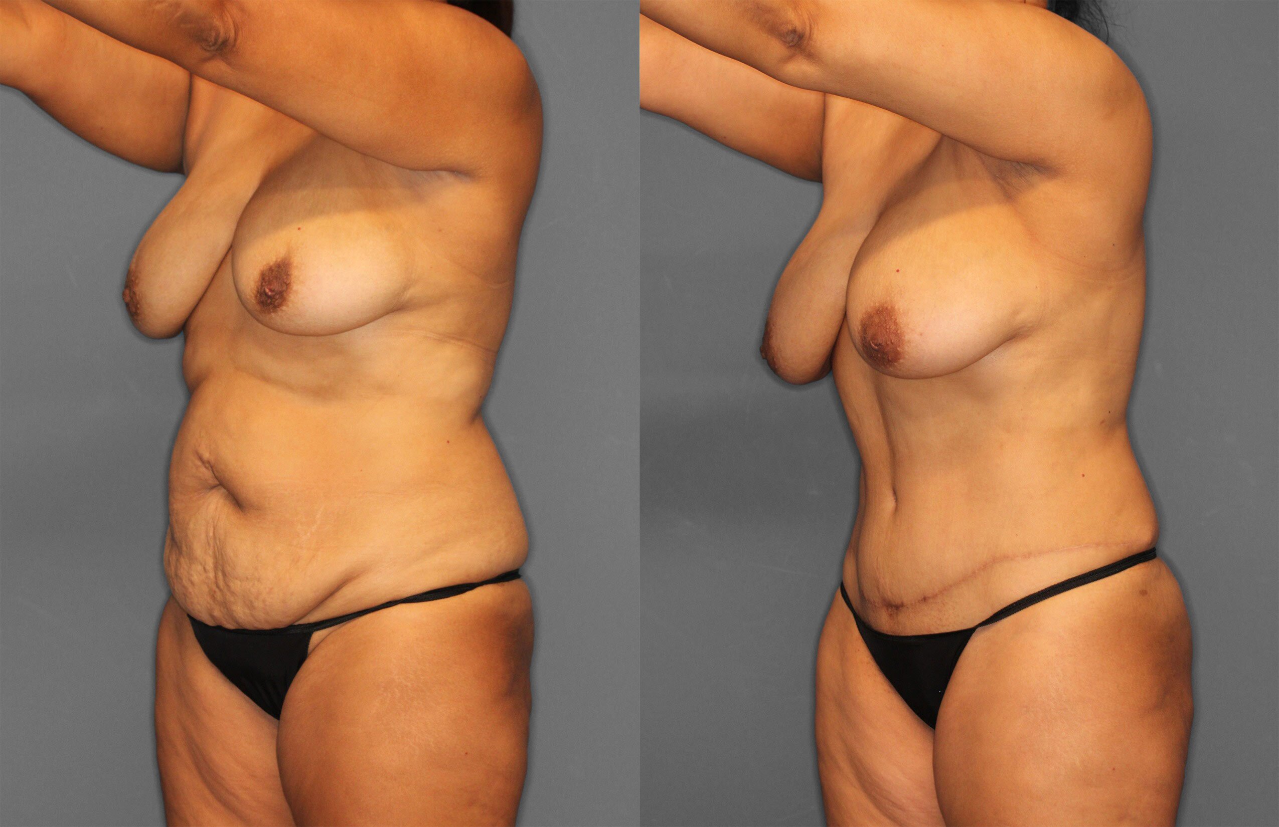 Tummy Tuck Before and After photo by Dr. Abigail Rodriguez in Houston, TX