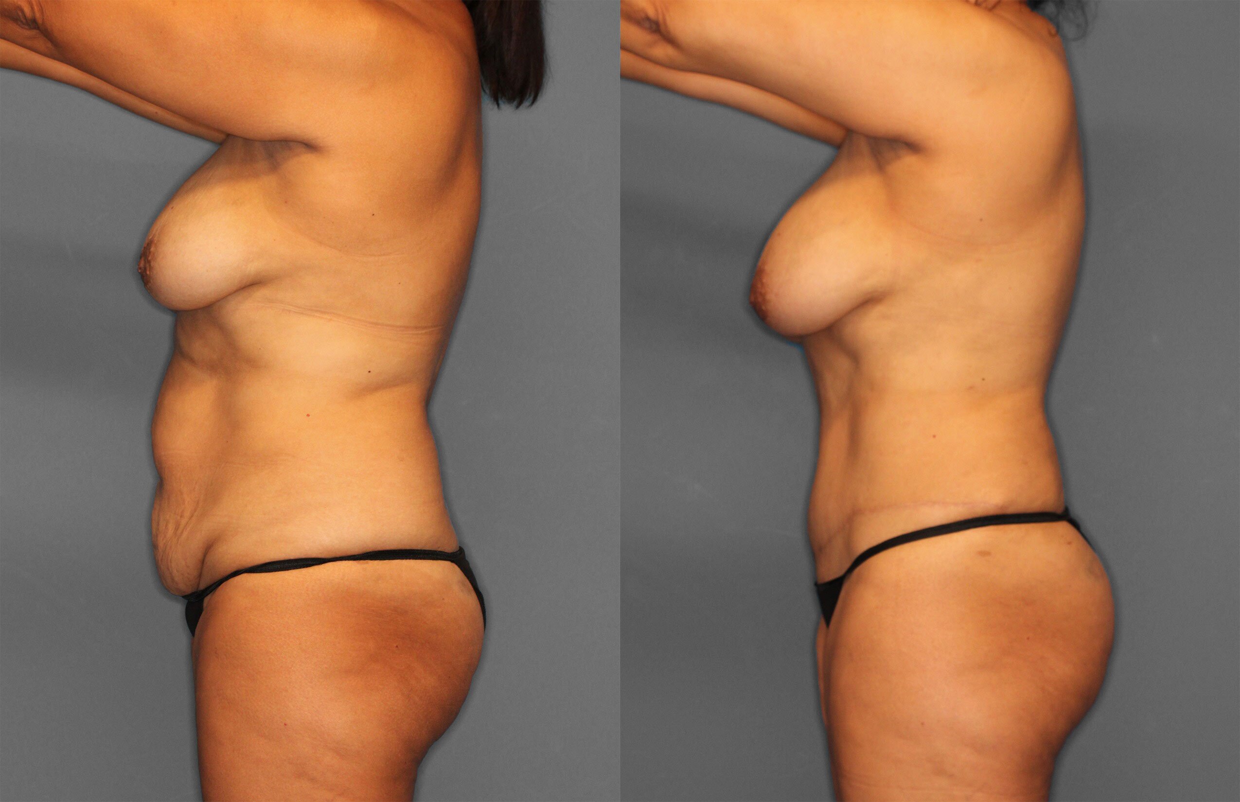 Tummy Tuck Before and After photo by Dr. Abigail Rodriguez in Houston, TX