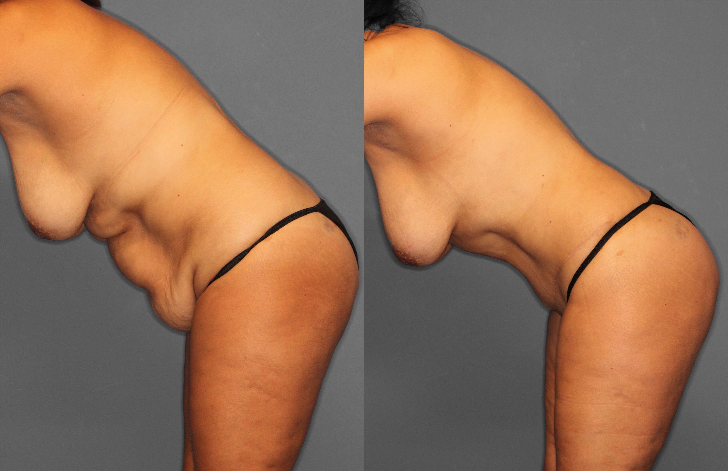 Tummy Tuck Before and After photo by Dr. Abigail Rodriguez in Houston, TX