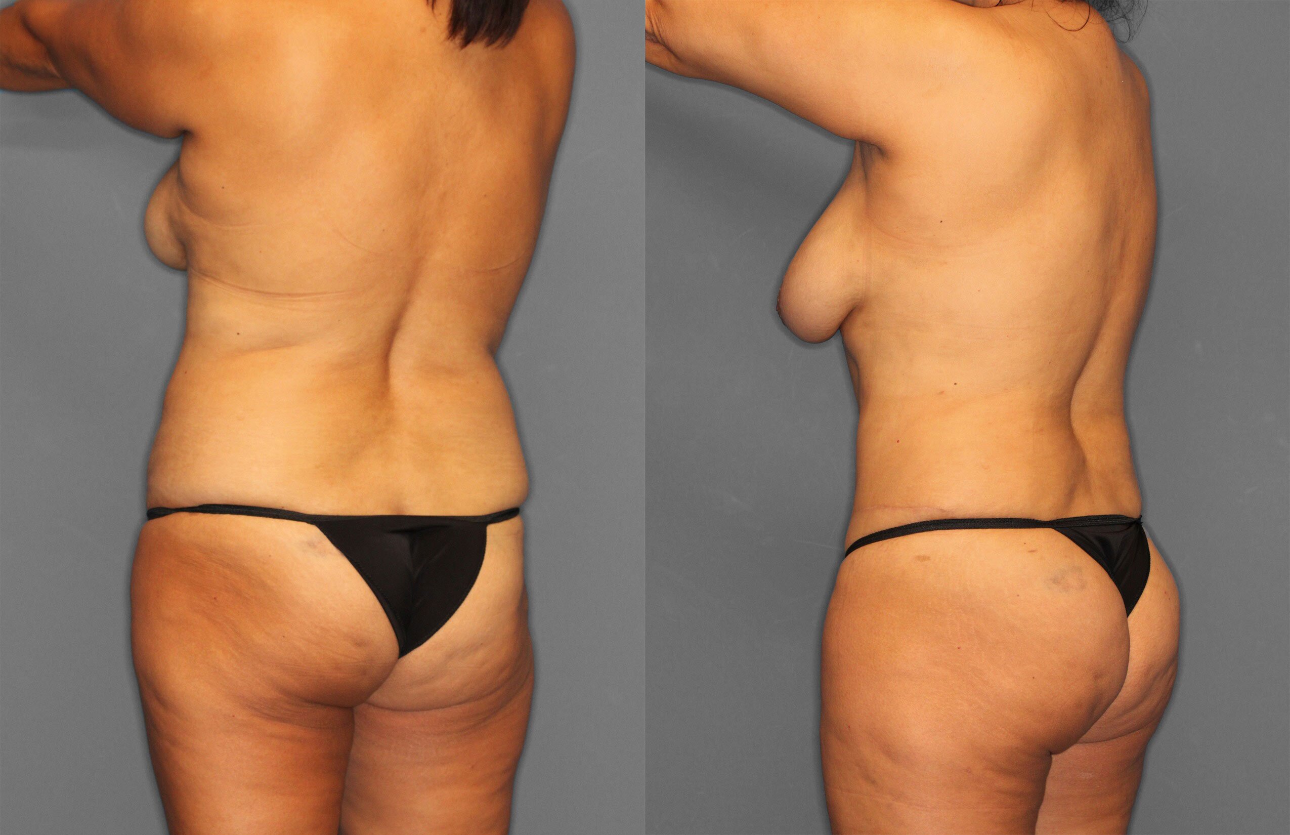 Tummy Tuck Before and After photo by Dr. Abigail Rodriguez in Houston, TX