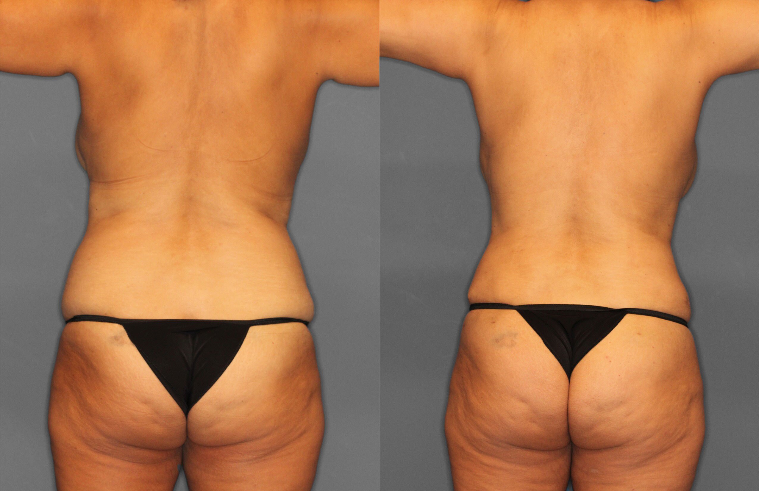 Tummy Tuck Before and After photo by Dr. Abigail Rodriguez in Houston, TX