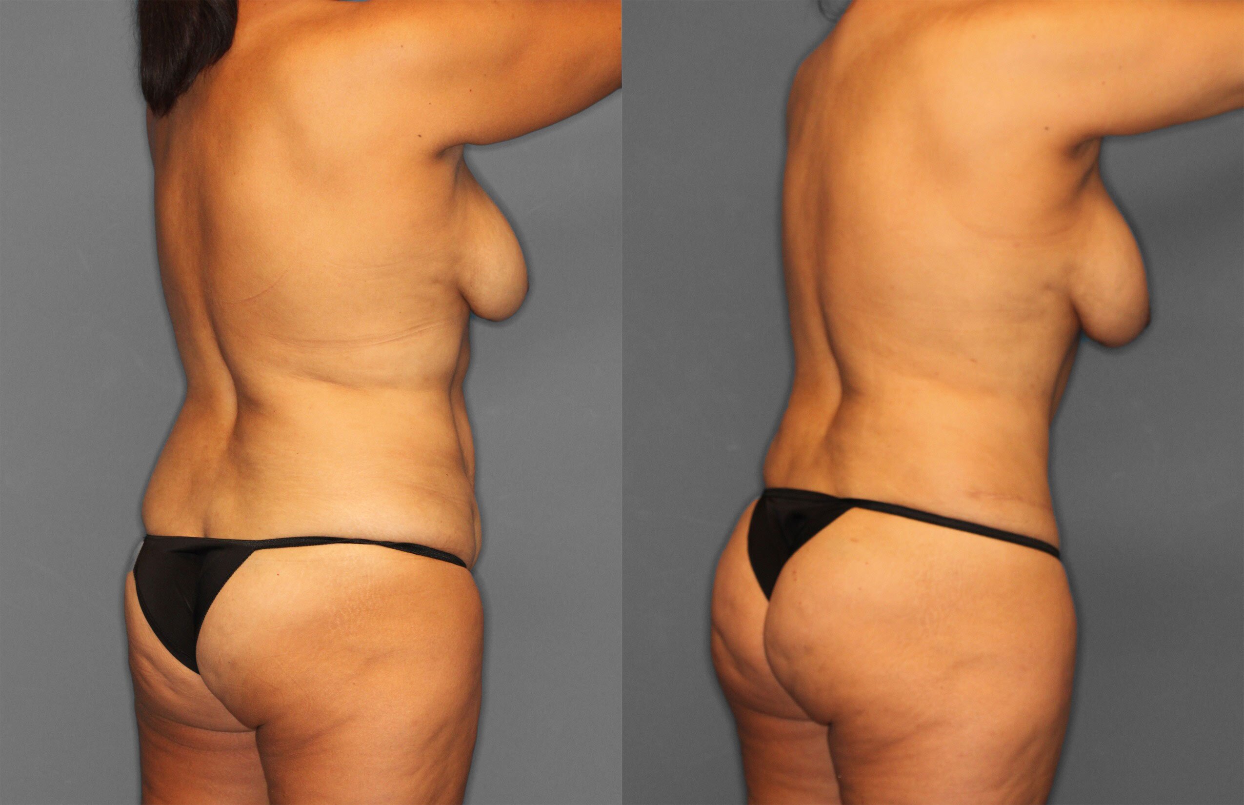 Tummy Tuck Before and After photo by Dr. Abigail Rodriguez in Houston, TX