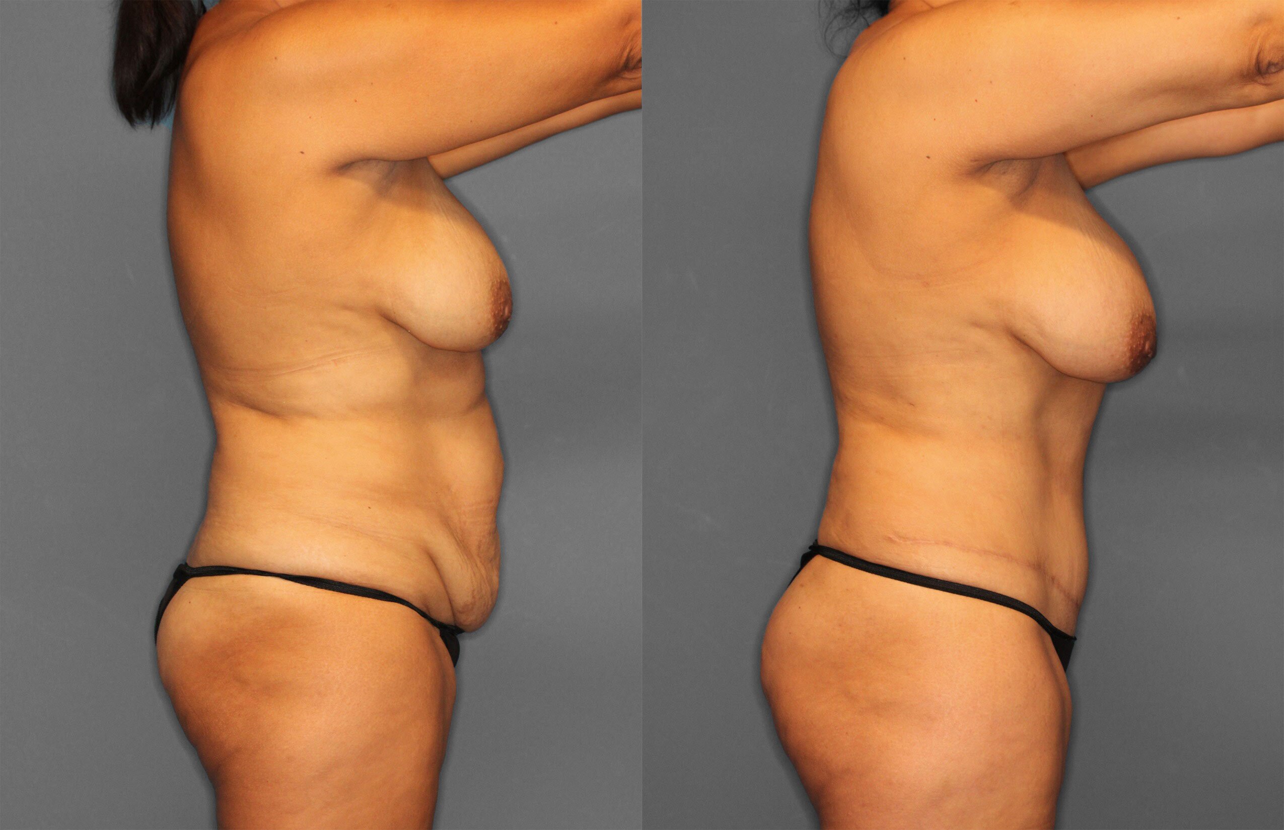 Tummy Tuck Before and After photo by Dr. Abigail Rodriguez in Houston, TX