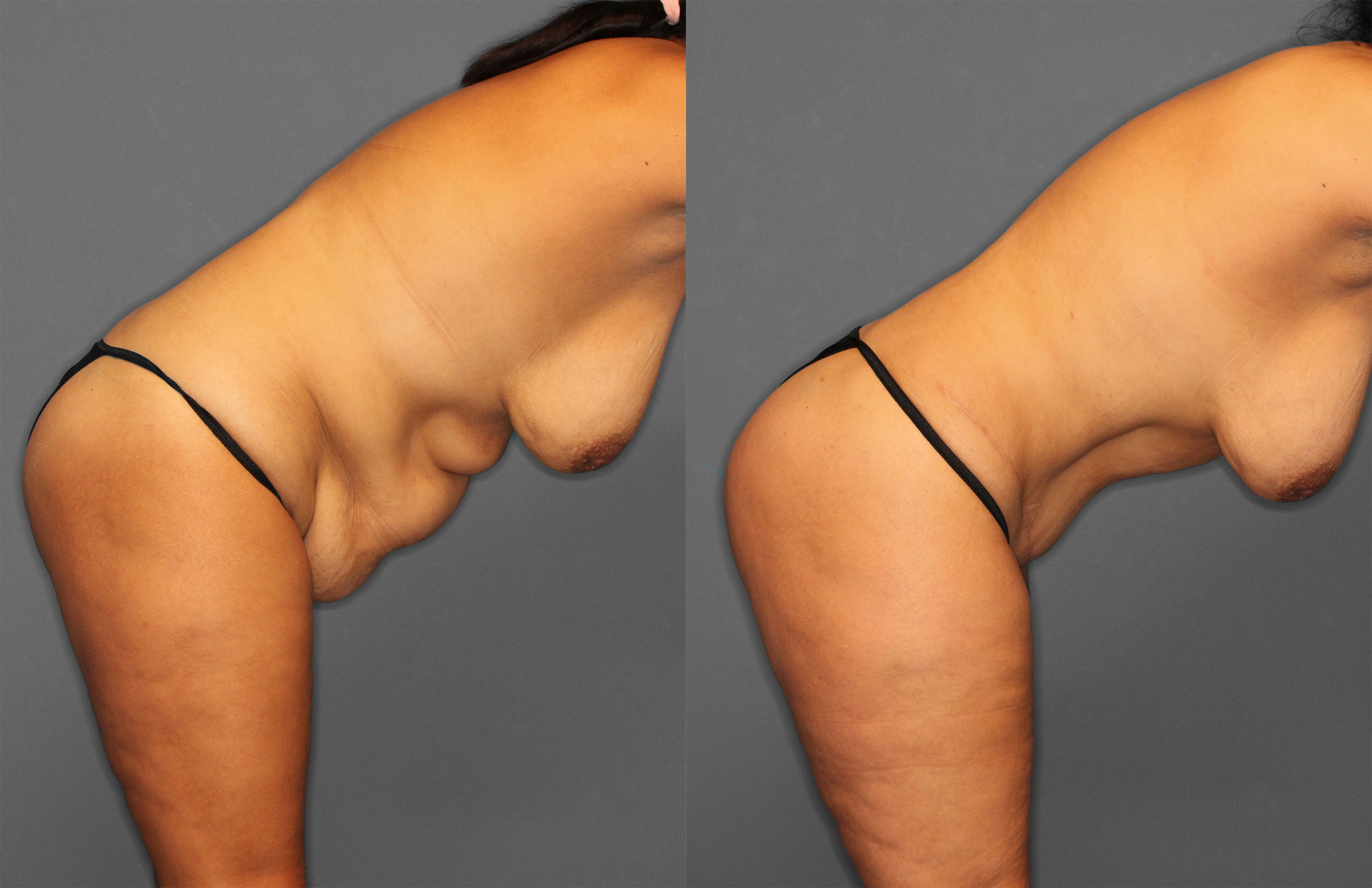Tummy Tuck Before and After photo by Dr. Abigail Rodriguez in Houston, TX