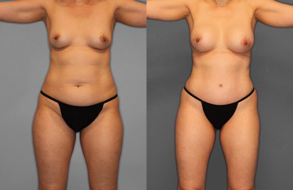 Tummy Tuck Before and After photo by Dr. Abigail Rodriguez in Houston, TX