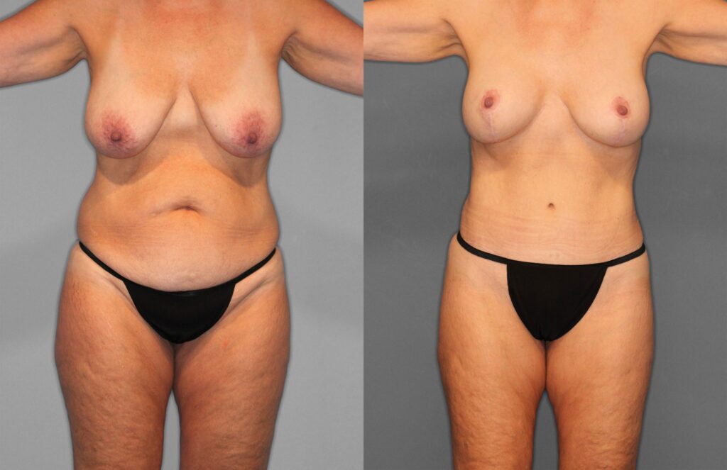 Tummy Tuck Before and After photo by Dr. Abigail Rodriguez in Houston, TX