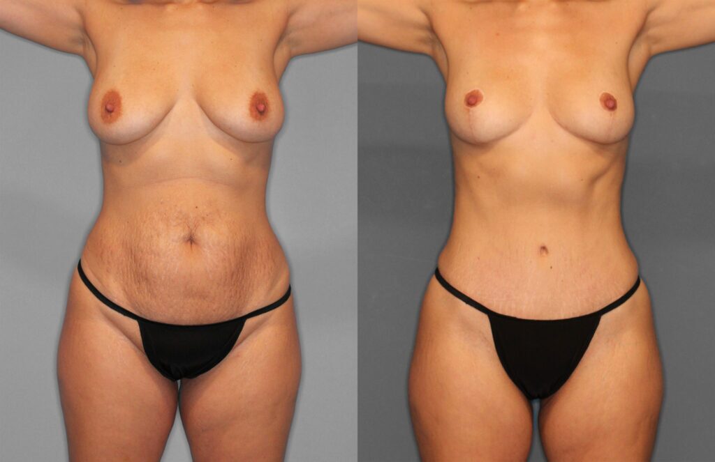 Tummy Tuck Before and After photo by Dr. Abigail Rodriguez in Houston, TX