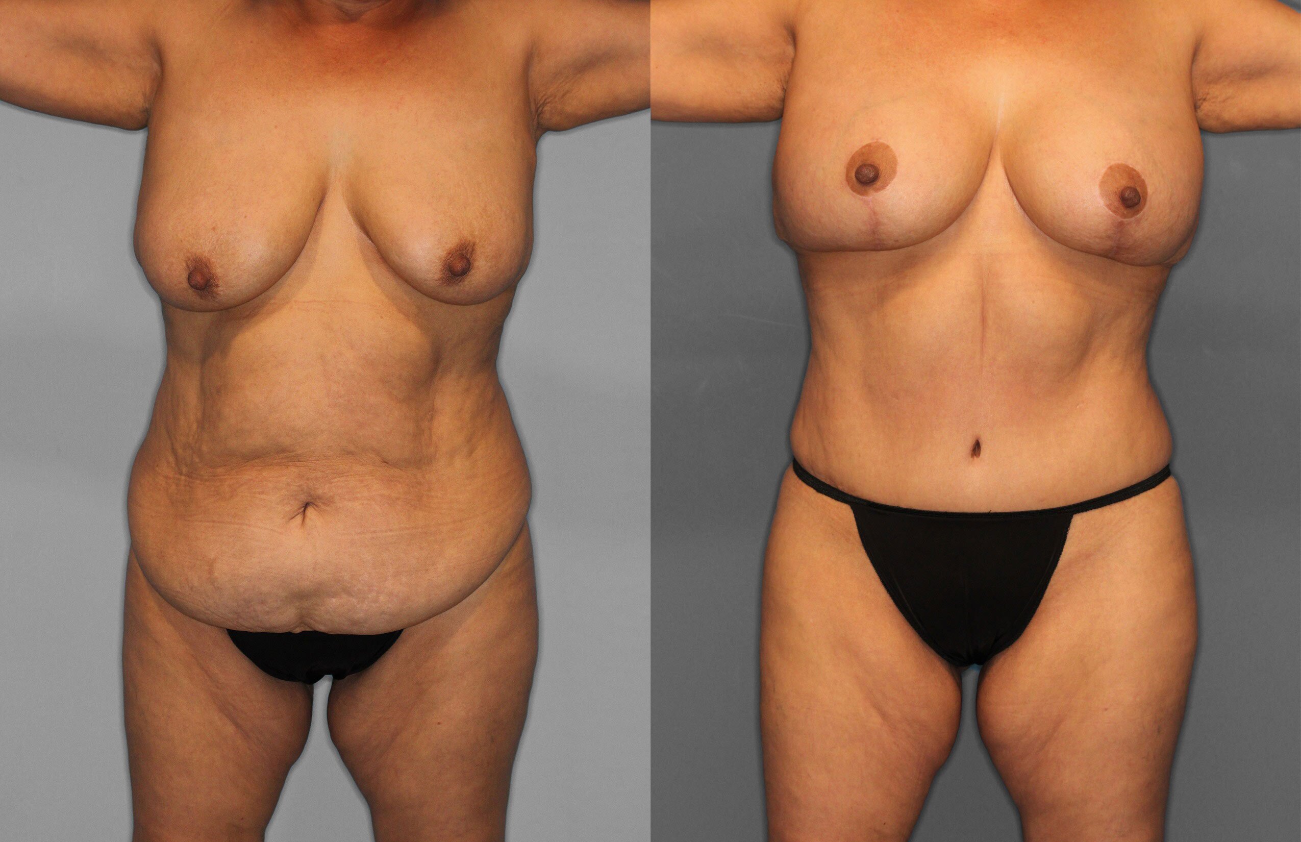Tummy Tuck Before and After photo by Dr. Abigail Rodriguez in Houston, TX