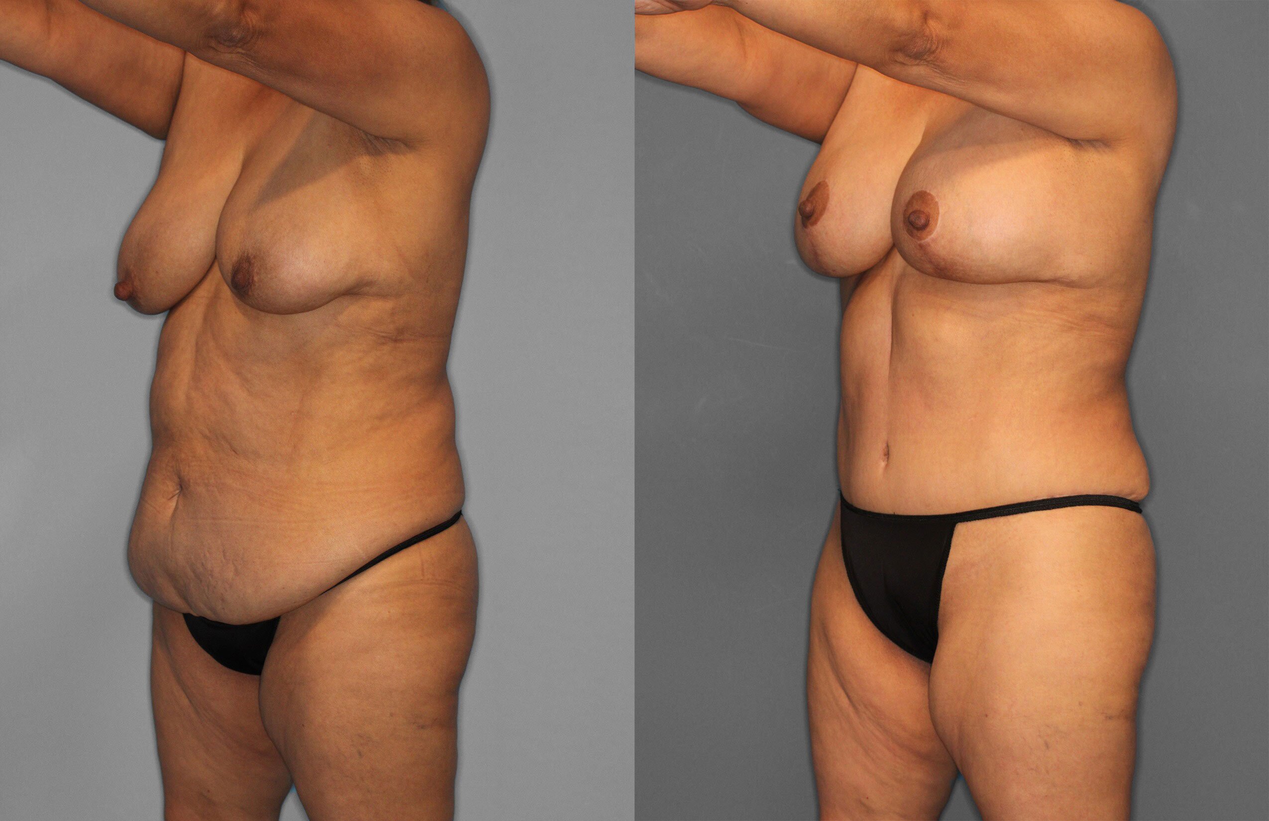Tummy Tuck Before and After photo by Dr. Abigail Rodriguez in Houston, TX