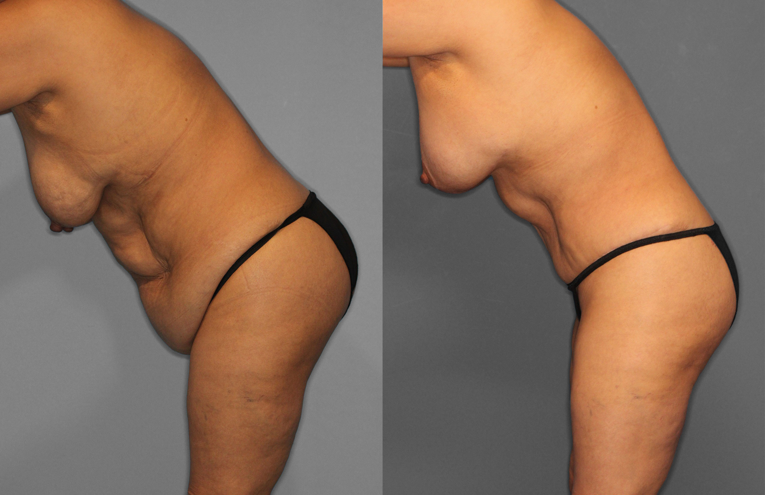 Tummy Tuck Before and After photo by Dr. Abigail Rodriguez in Houston, TX