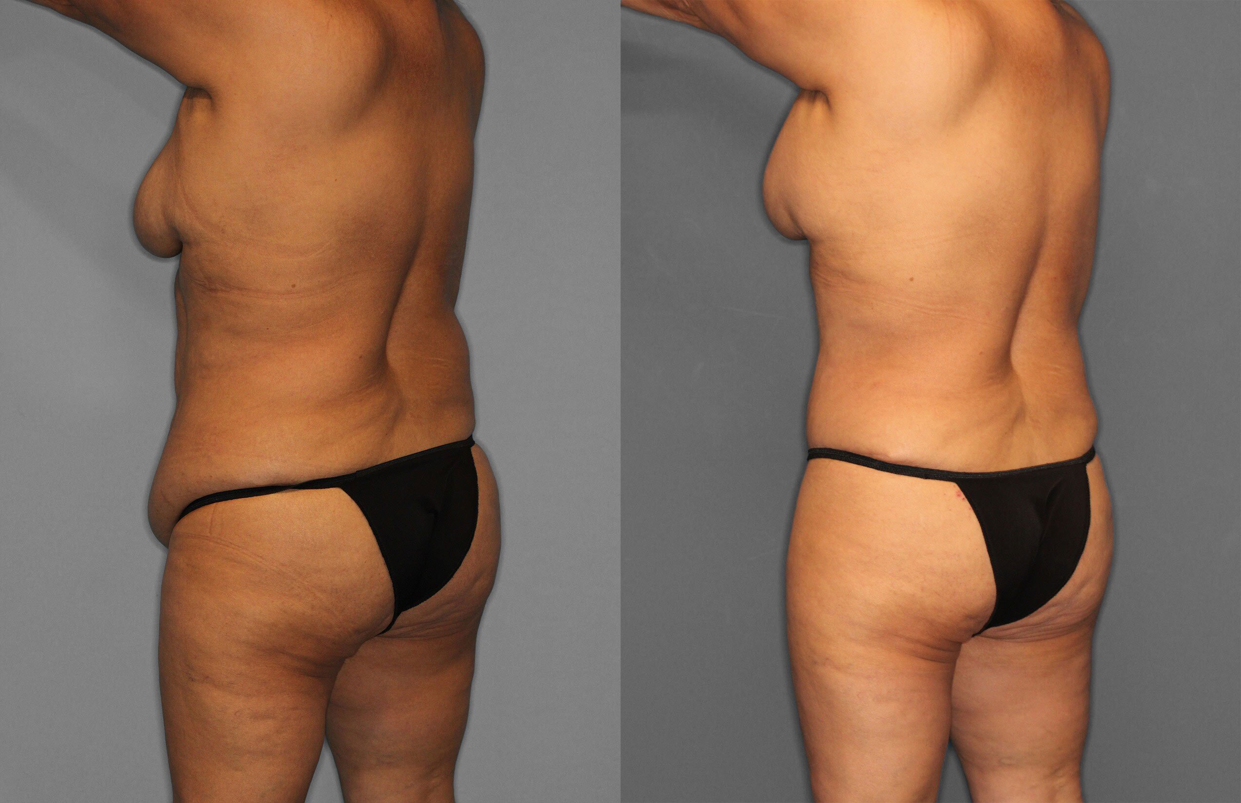 Tummy Tuck Before and After photo by Dr. Abigail Rodriguez in Houston, TX