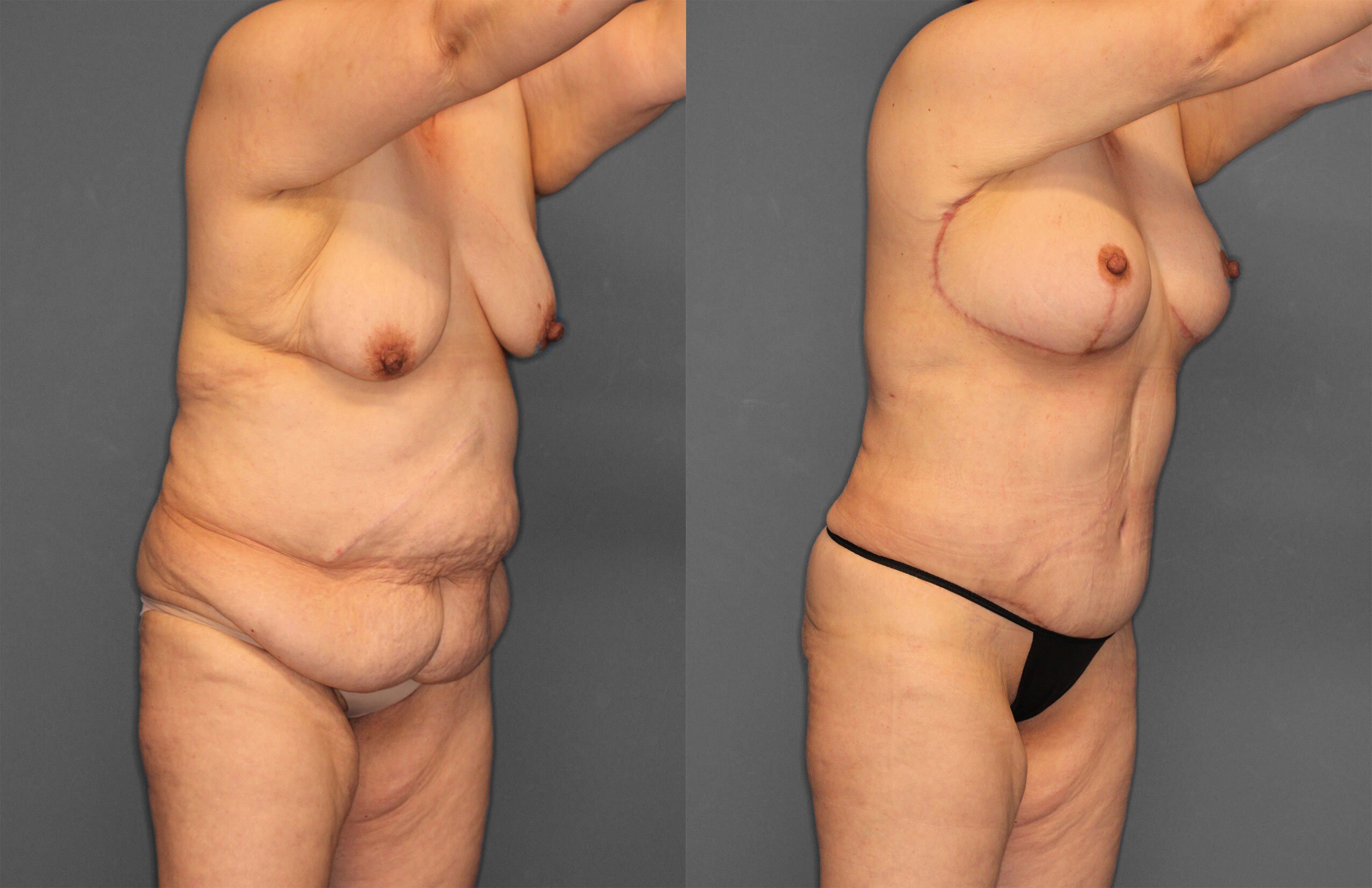 Tummy Tuck Before and After photo by Dr. Abigail Rodriguez in Houston, TX