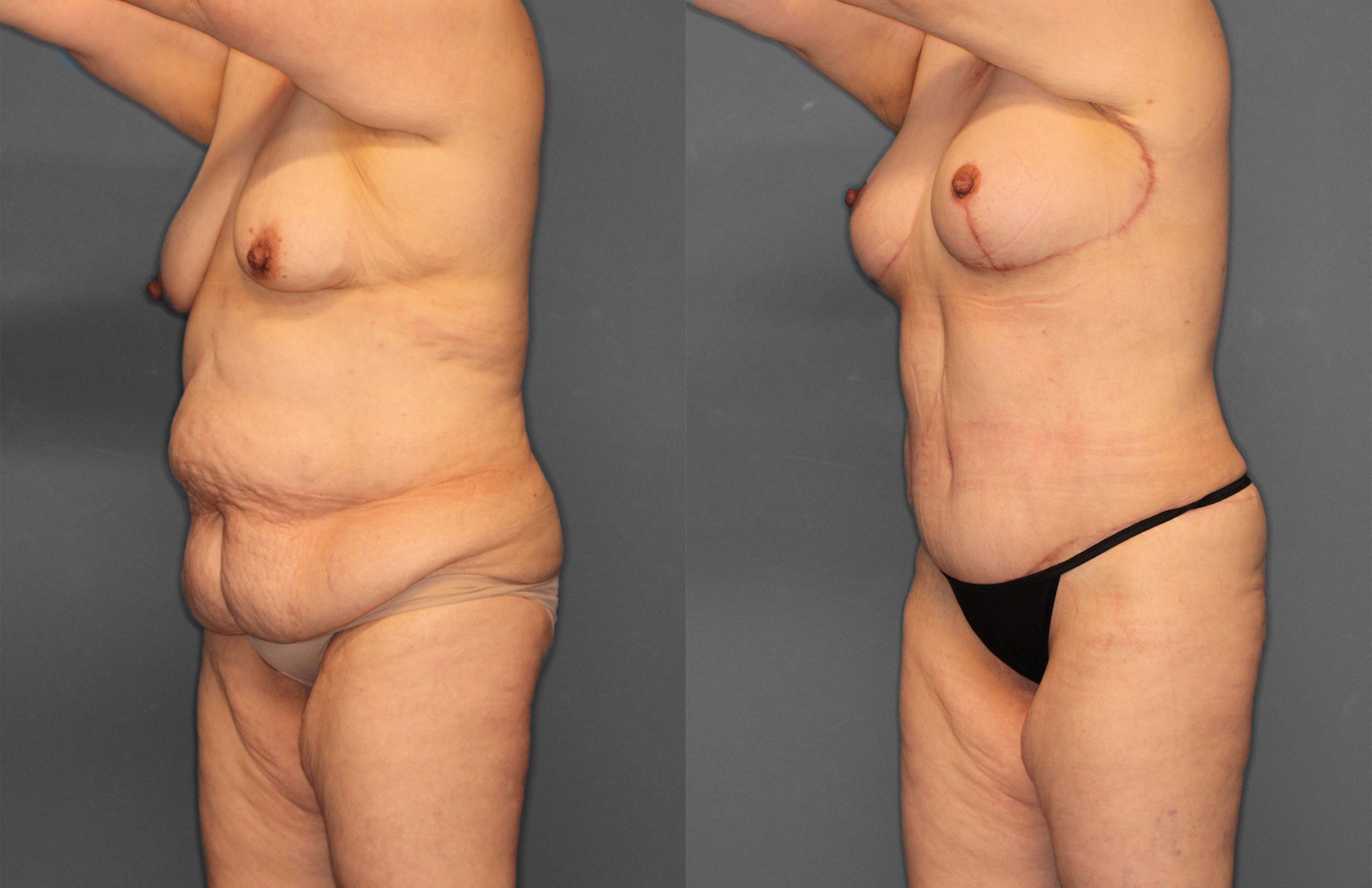 Tummy Tuck Before and After photo by Dr. Abigail Rodriguez in Houston, TX