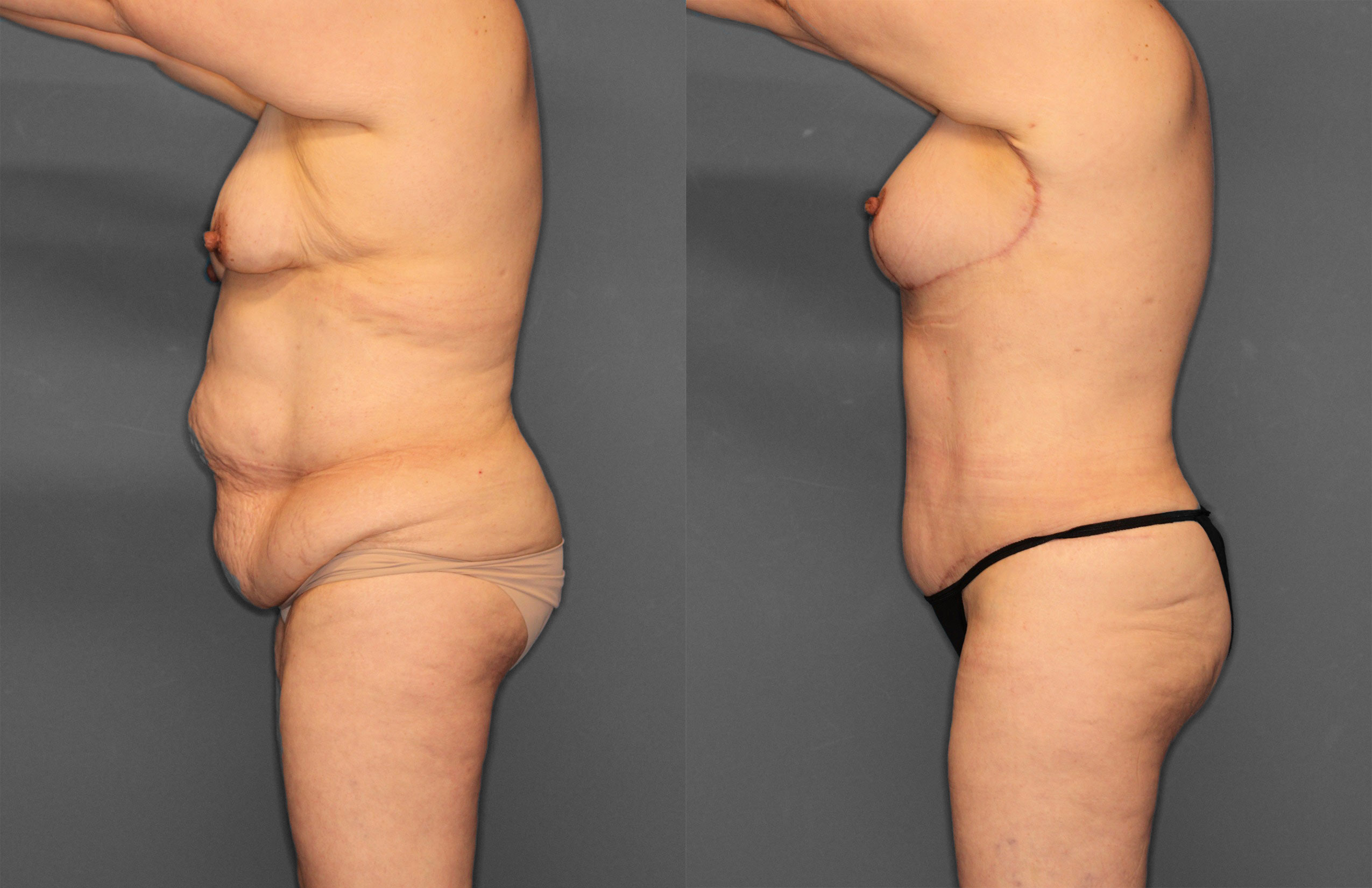 Tummy Tuck Before and After photo by Dr. Abigail Rodriguez in Houston, TX
