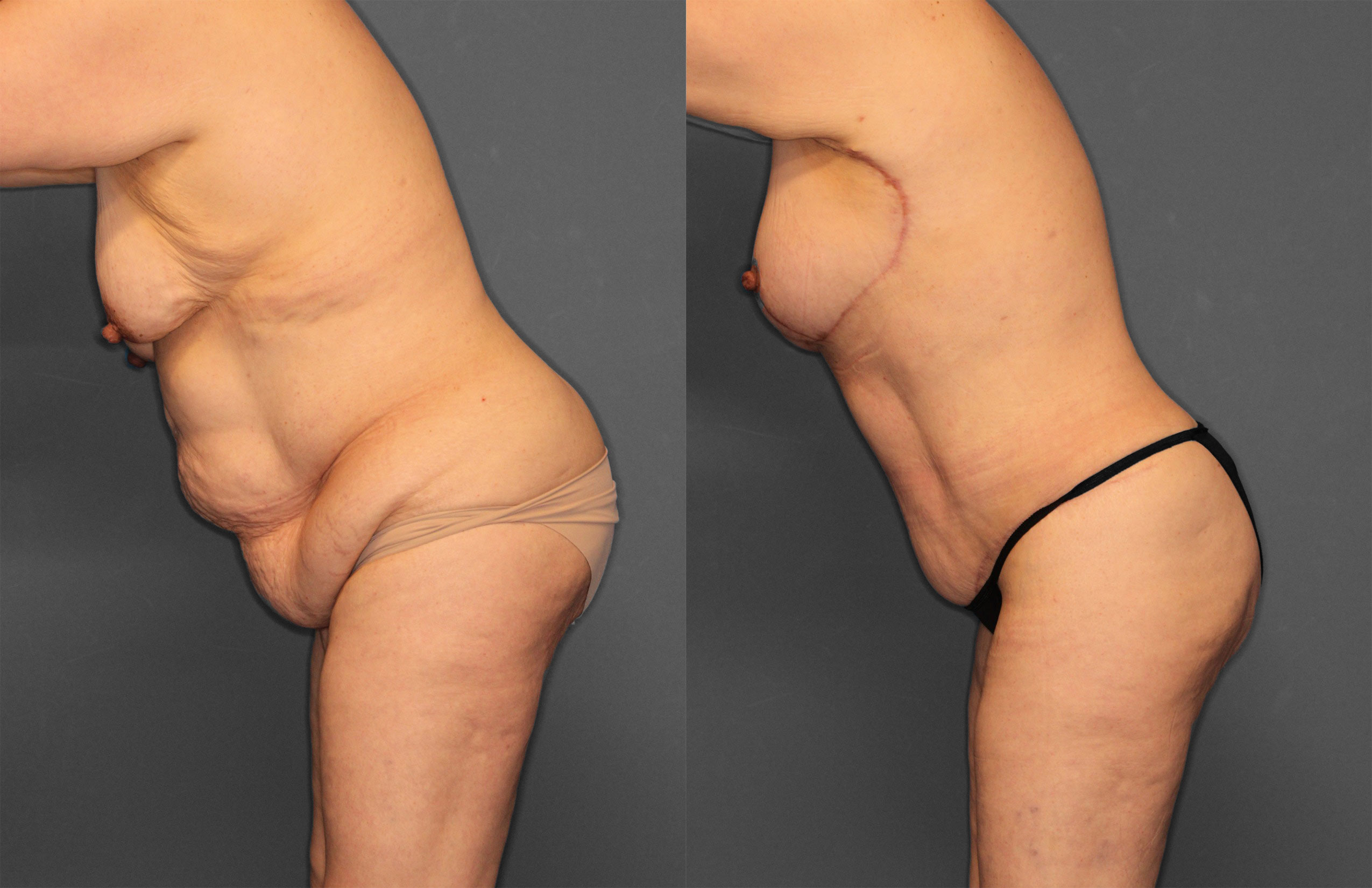 Tummy Tuck Before and After photo by Dr. Abigail Rodriguez in Houston, TX