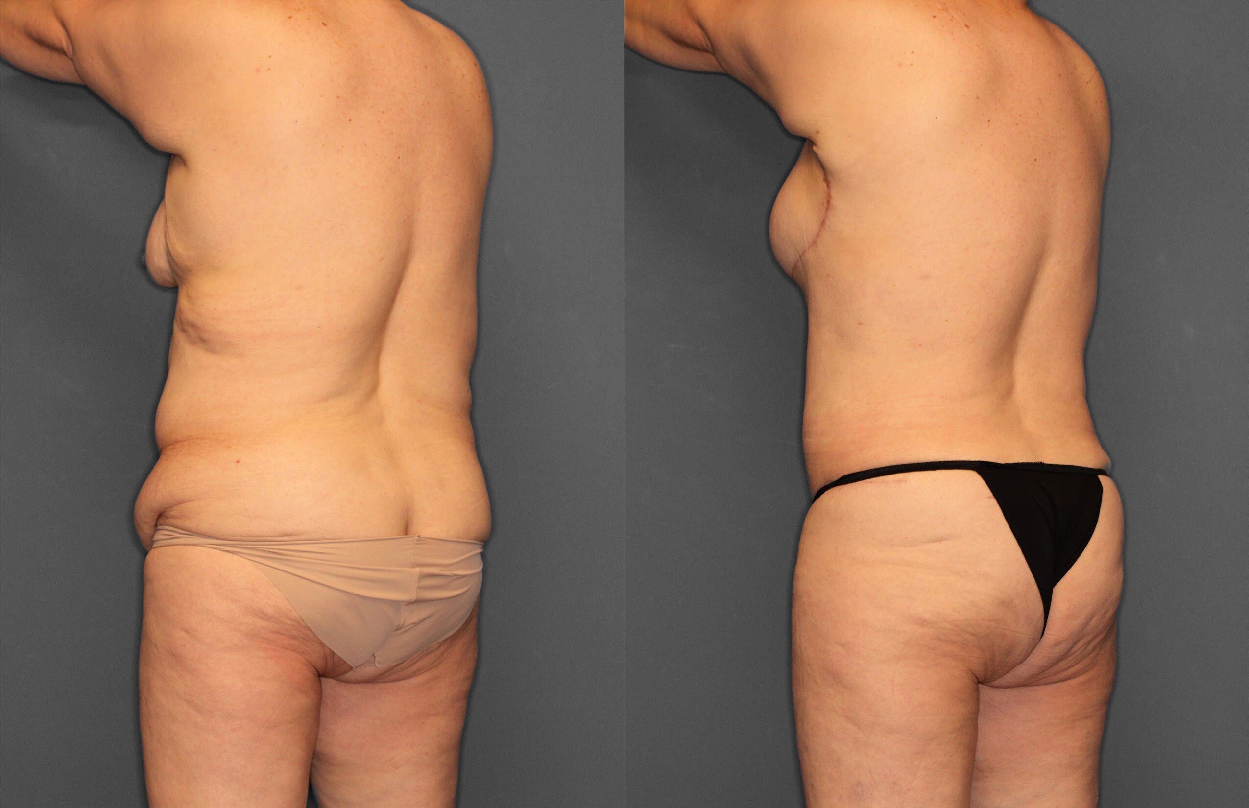 Tummy Tuck Before and After photo by Dr. Abigail Rodriguez in Houston, TX