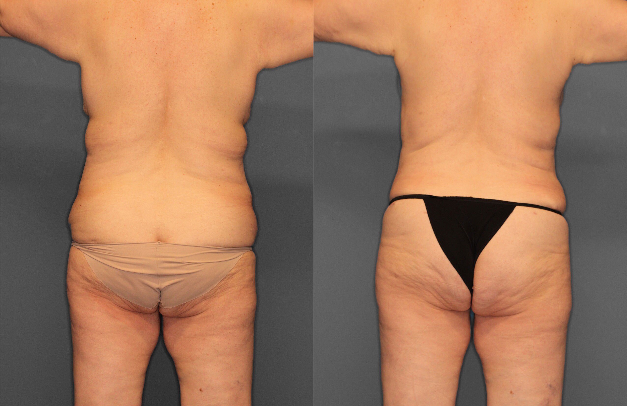 Tummy Tuck Before and After photo by Dr. Abigail Rodriguez in Houston, TX