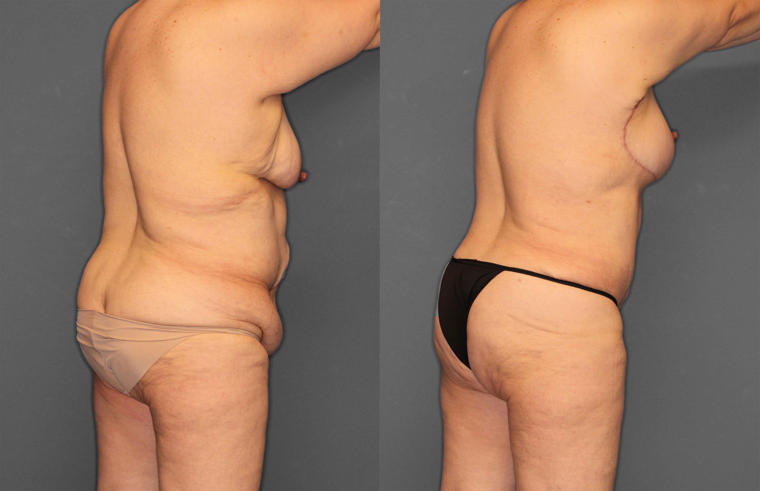 Tummy Tuck Before and After photo by Dr. Abigail Rodriguez in Houston, TX