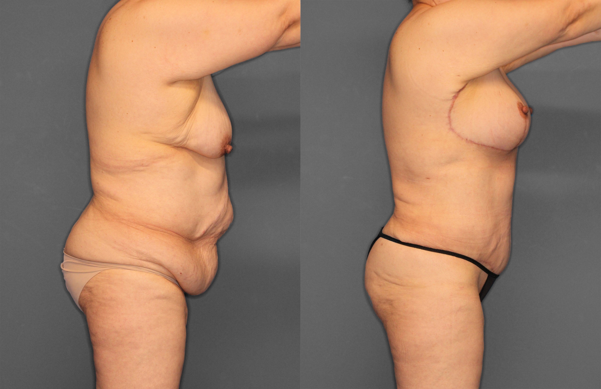 Tummy Tuck Before and After photo by Dr. Abigail Rodriguez in Houston, TX