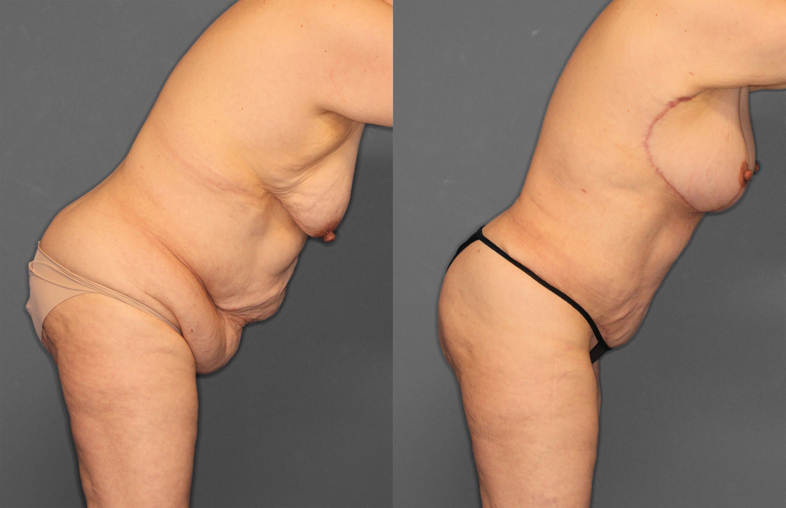 Tummy Tuck Before and After photo by Dr. Abigail Rodriguez in Houston, TX