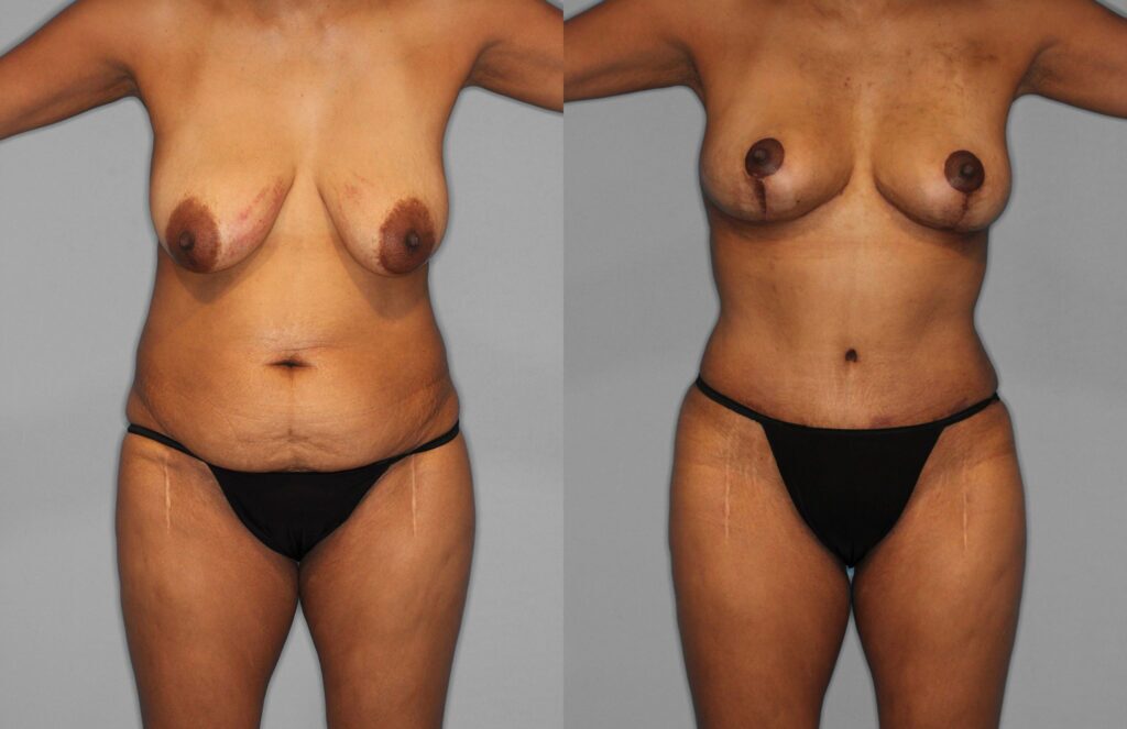 Tummy Tuck Before and After photo by Dr. Abigail Rodriguez in Houston, TX