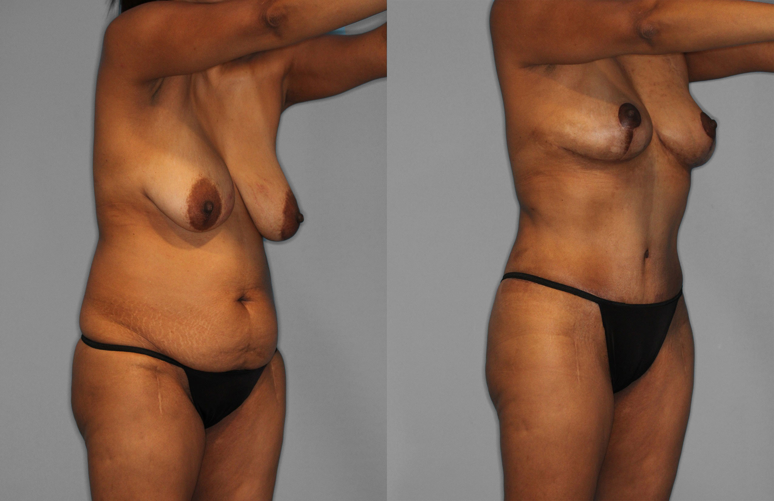 Tummy Tuck Before and After photo by Dr. Abigail Rodriguez in Houston, TX