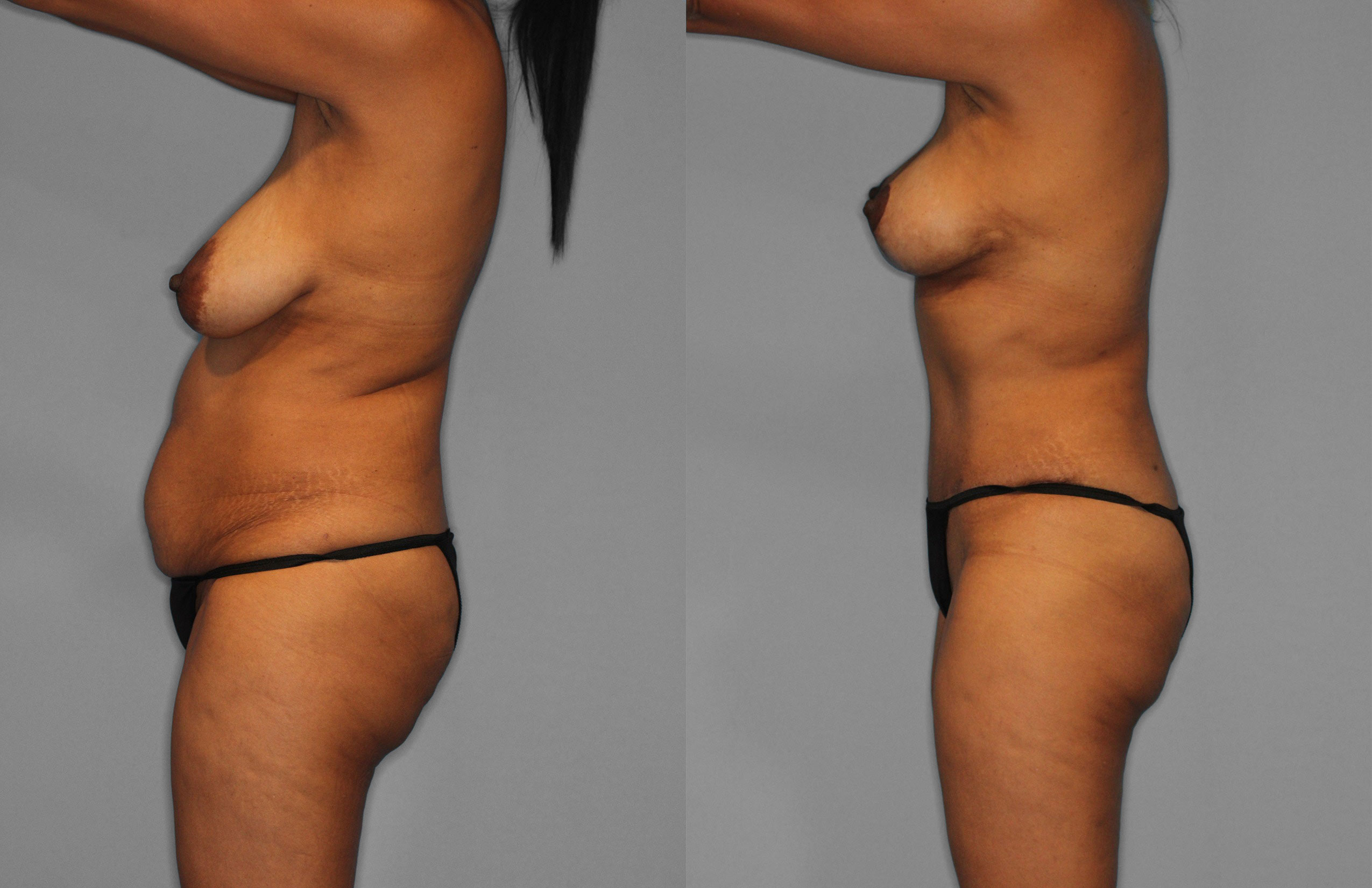 Tummy Tuck Before and After photo by Dr. Abigail Rodriguez in Houston, TX