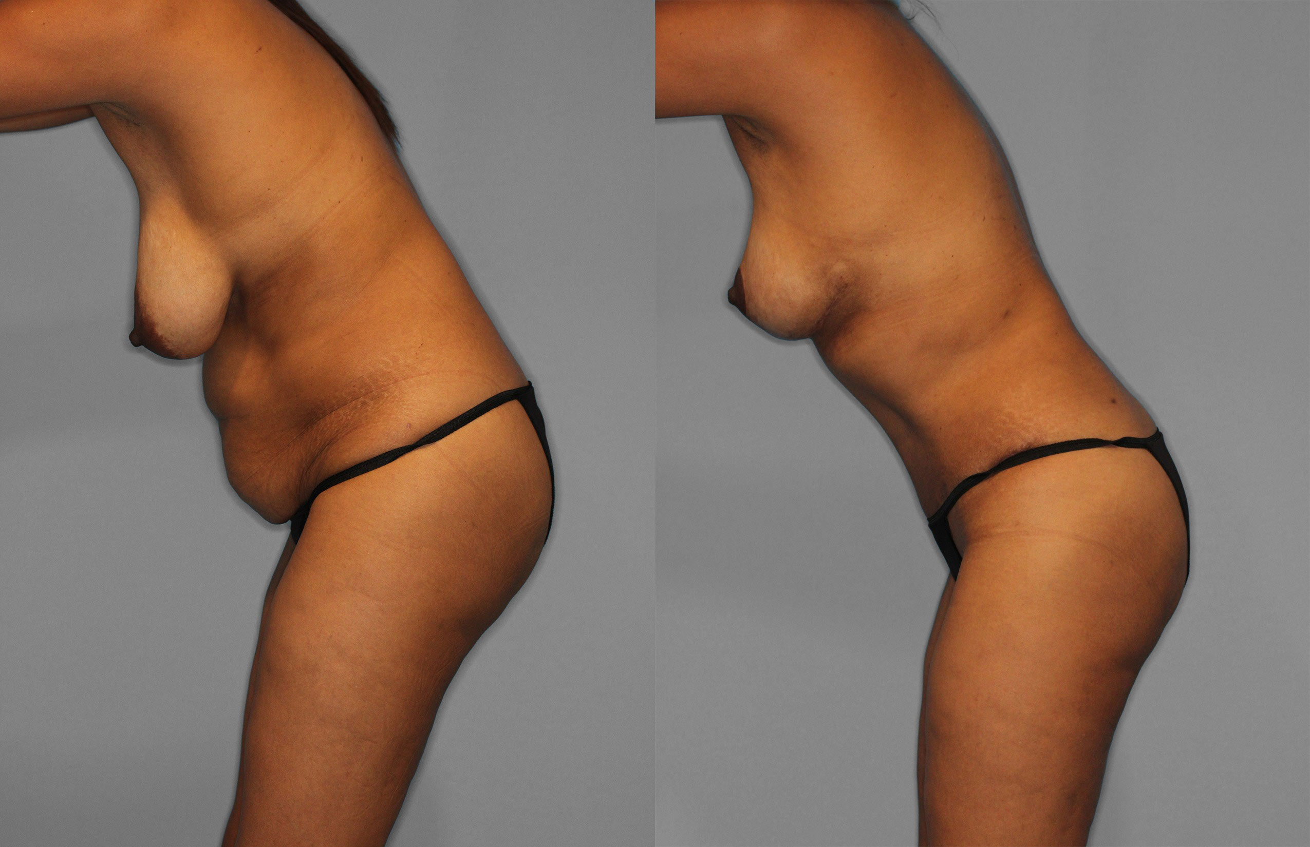 Tummy Tuck Before and After photo by Dr. Abigail Rodriguez in Houston, TX