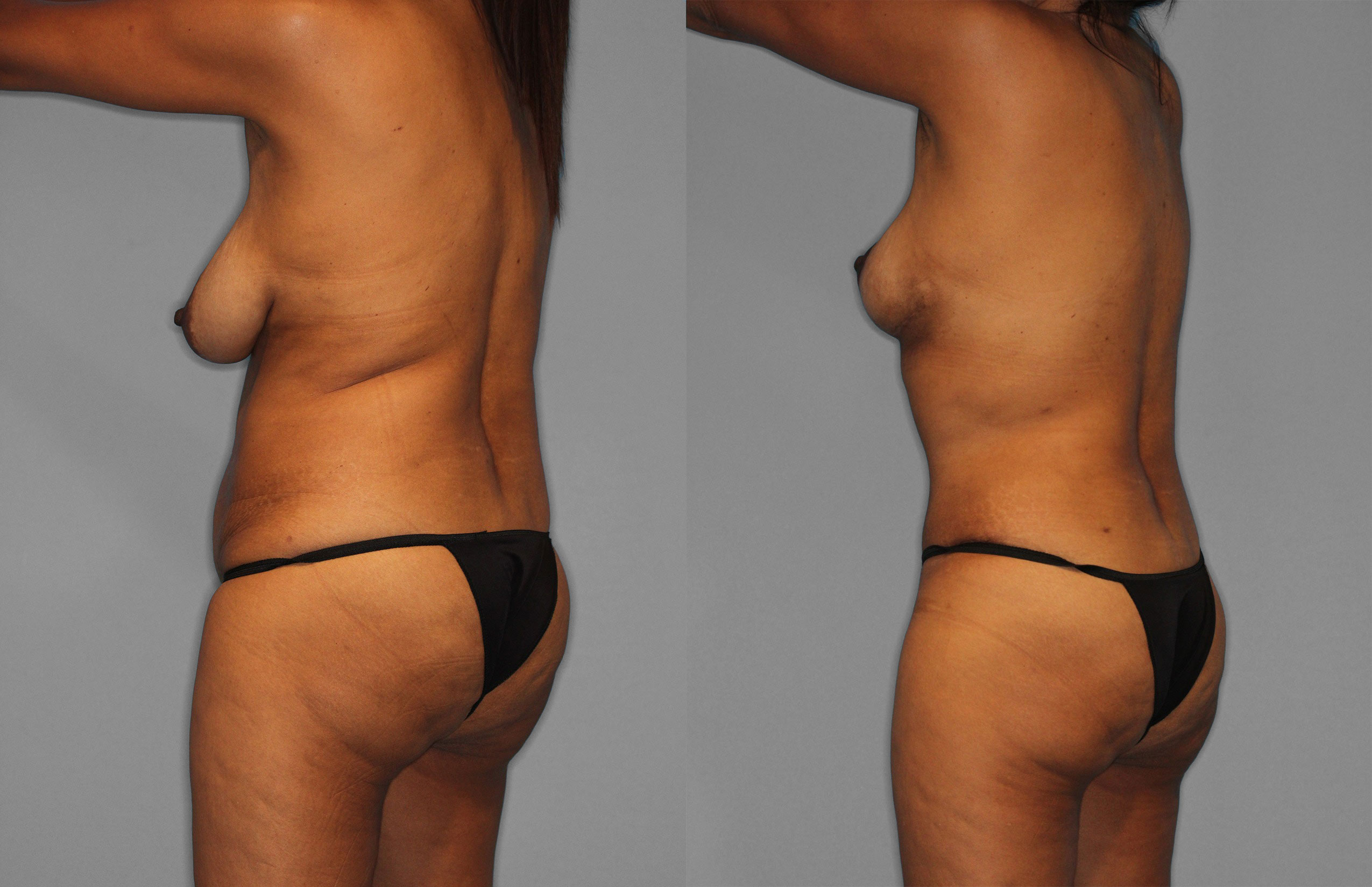Tummy Tuck Before and After photo by Dr. Abigail Rodriguez in Houston, TX